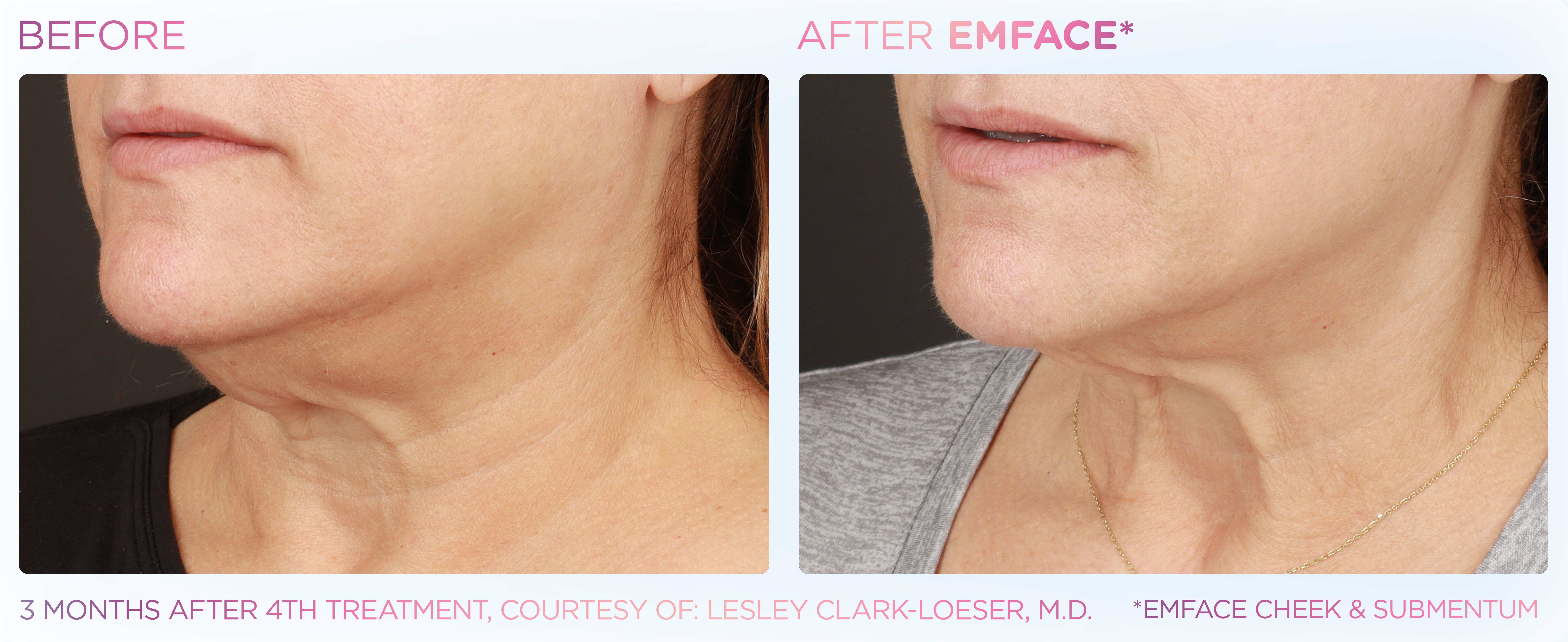 Double Chin Treatment, manufacturer before-and-after example 1; before on the left and after on the right