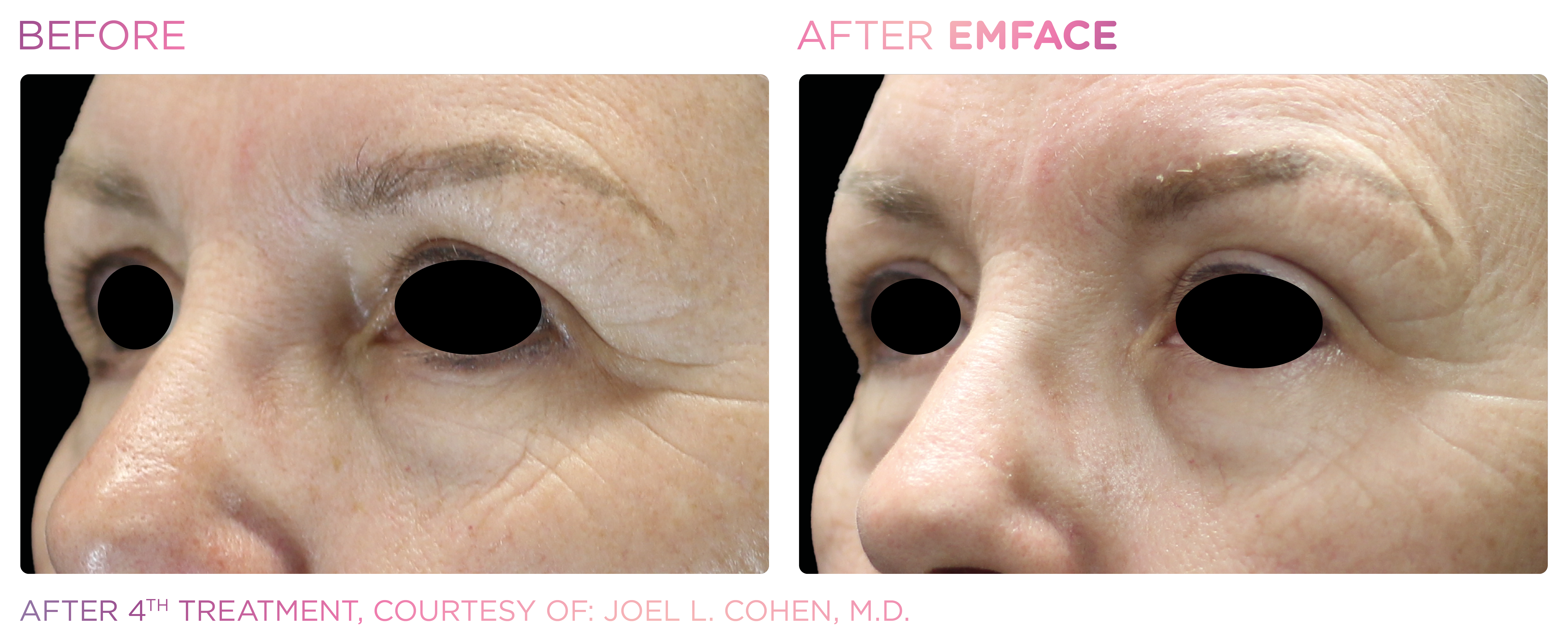 Under-Eye Treatment, manufacturer before-and-after example 1; before on the left and after on the right