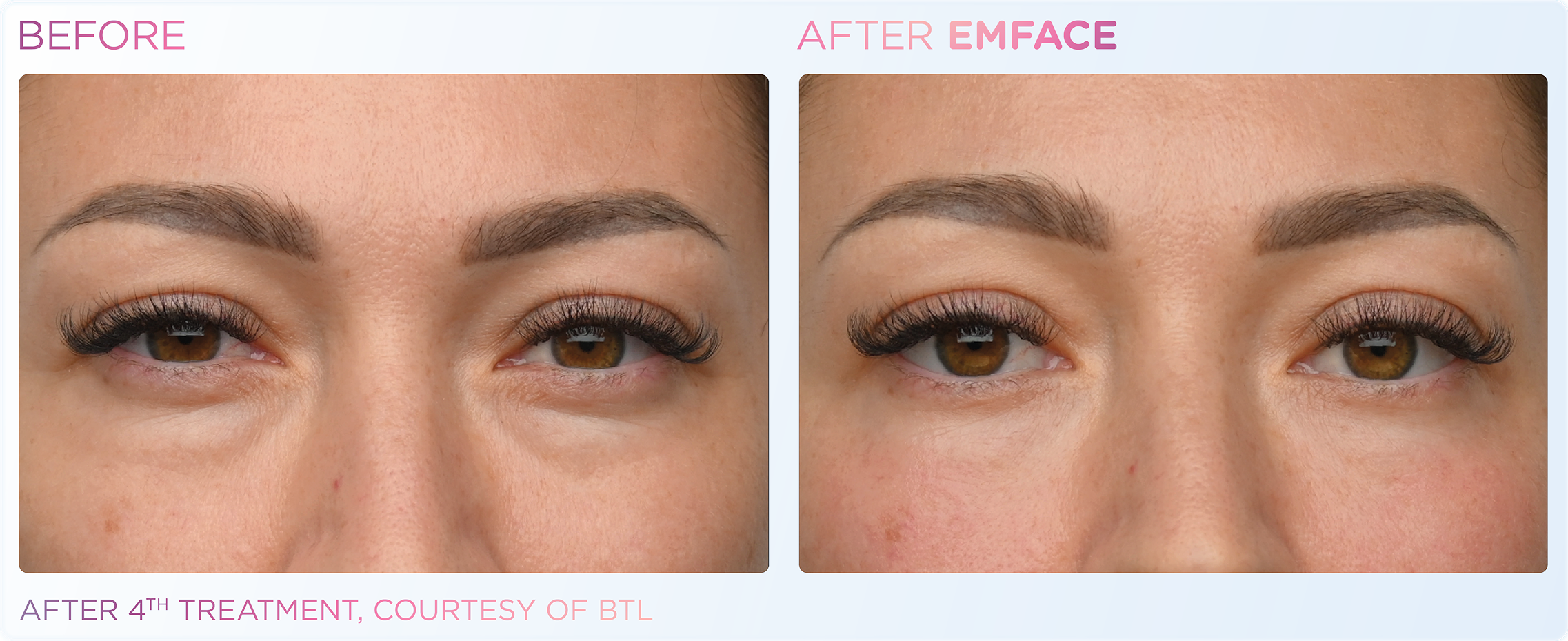 Under-Eye Treatment, manufacturer before-and-after example 2; before on the left and after on the right