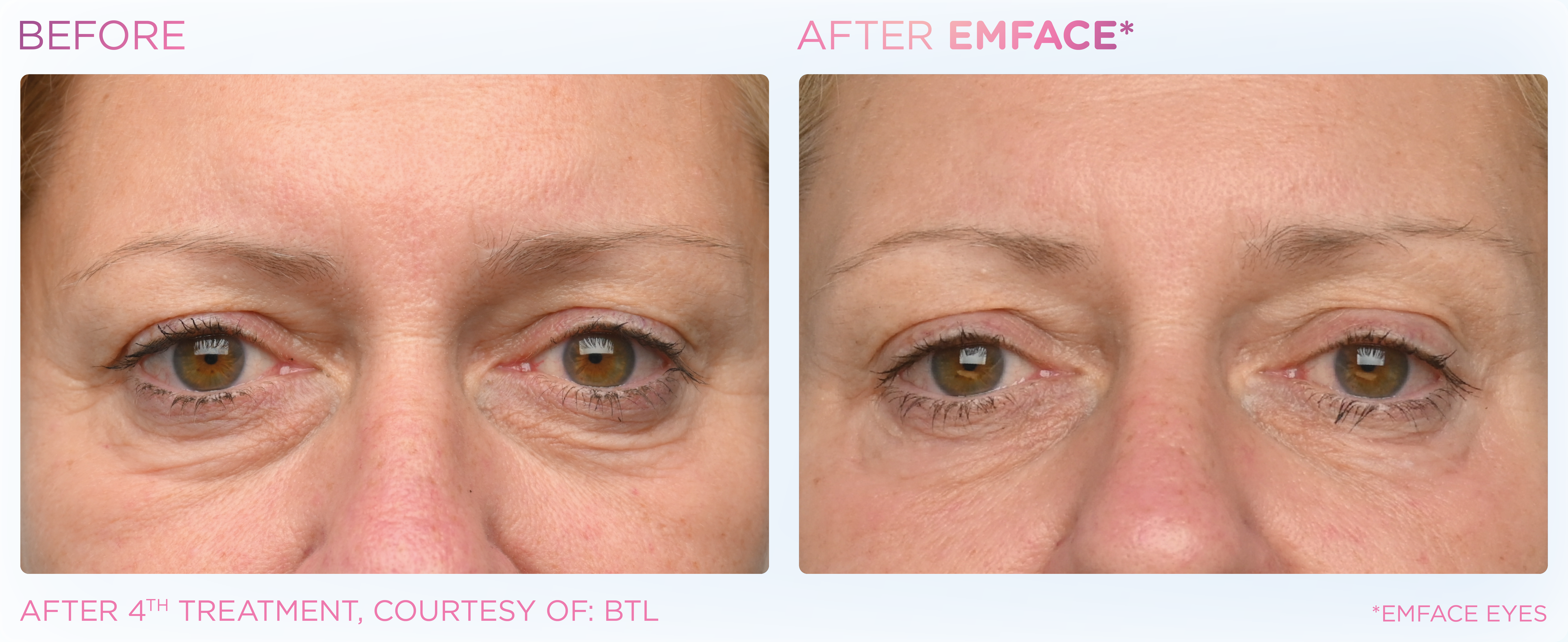 Under-Eye Treatment, manufacturer before-and-after example 3; before on the left and after on the right