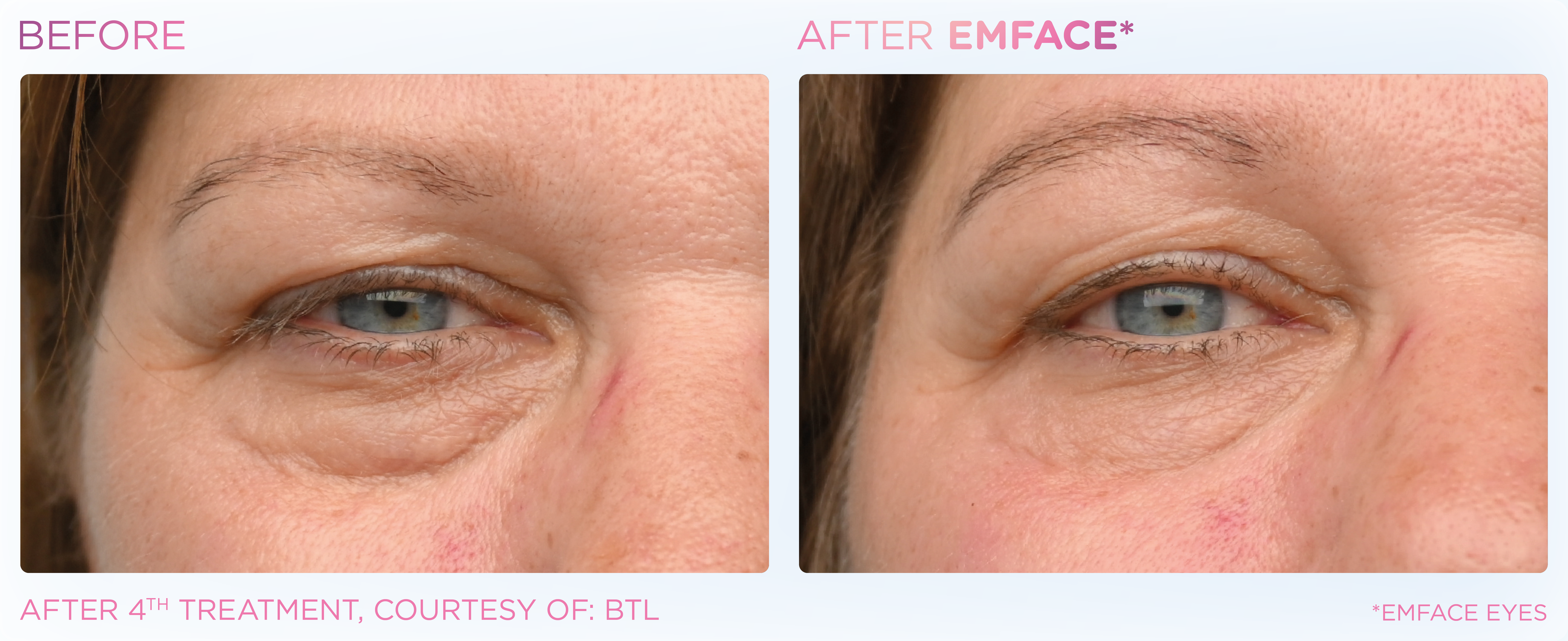 Under-Eye Treatment, manufacturer before-and-after example 4; before on the left and after on the right
