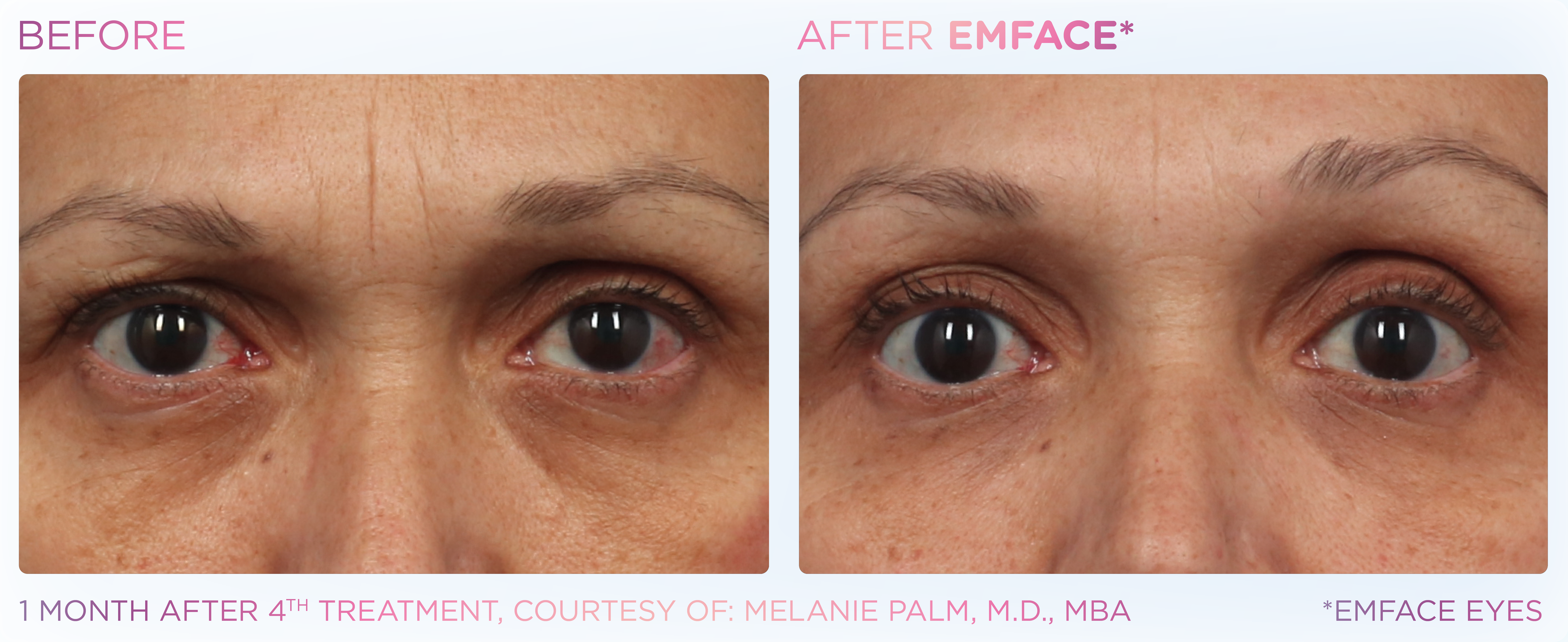 Under-Eye Treatment, manufacturer before-and-after example 5; before on the left and after on the right