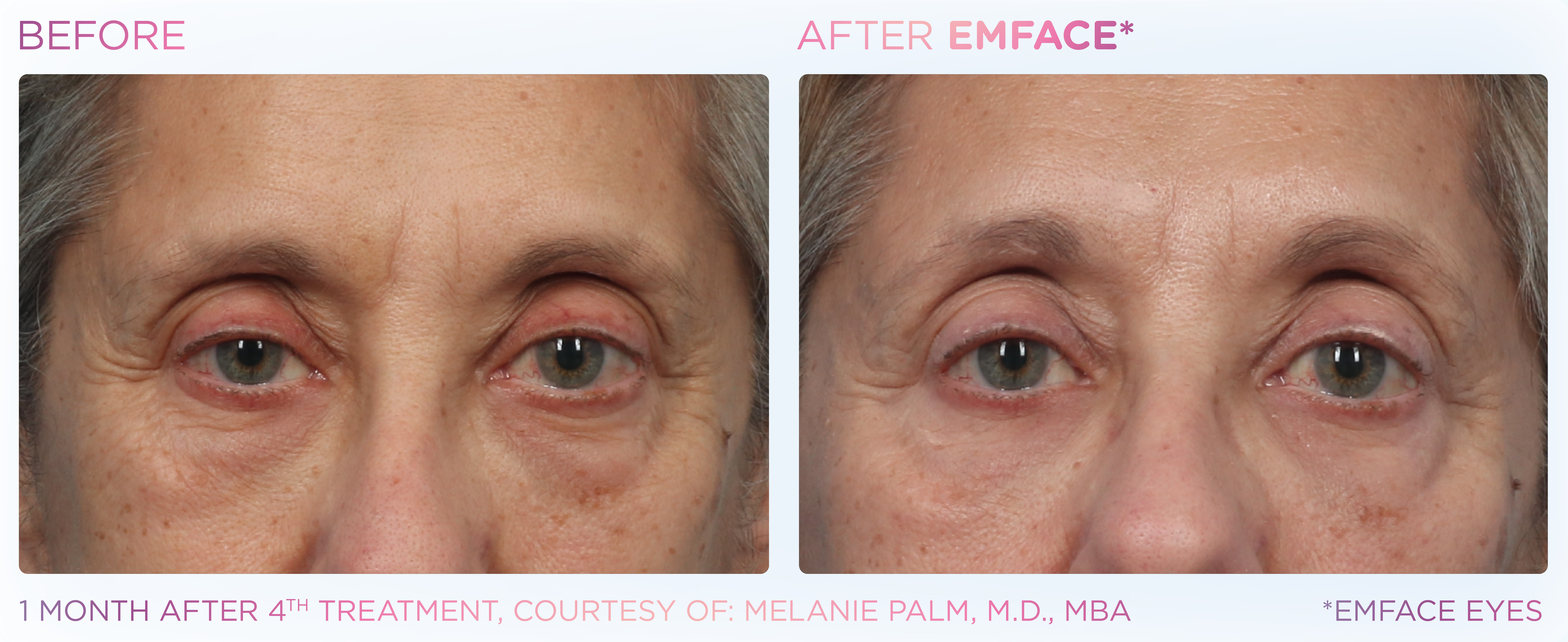 Under-Eye Treatment, manufacturer before-and-after example 6; before on the left and after on the right