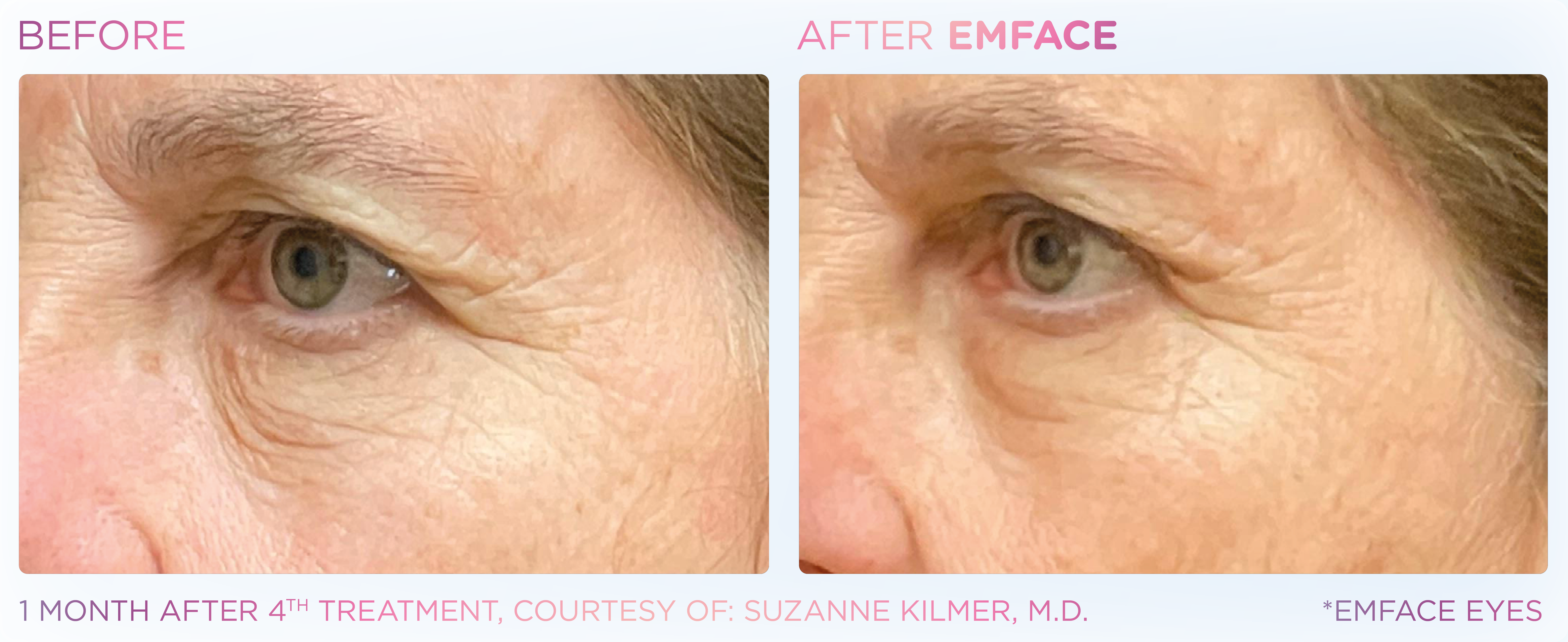 Under-Eye Treatment, manufacturer before-and-after example 7; before on the left and after on the right