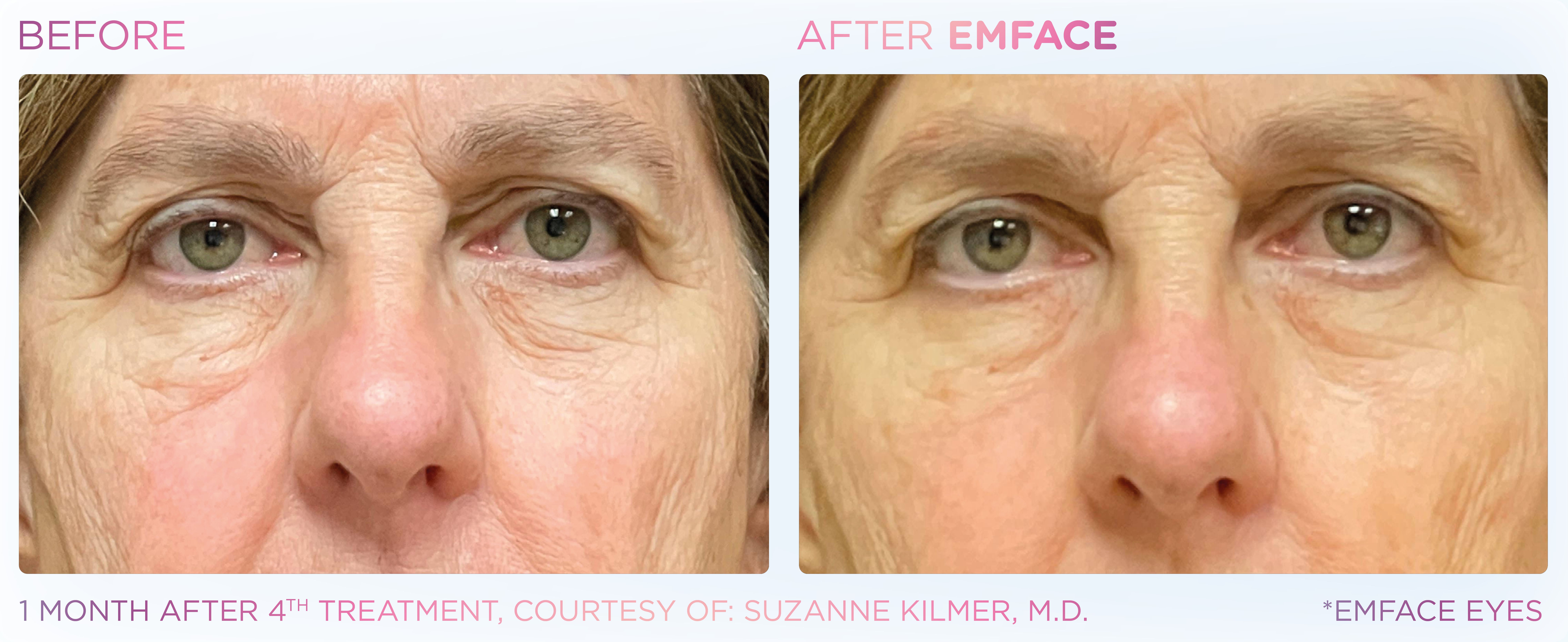 Under-Eye Treatment, manufacturer before-and-after example 8; before on the left and after on the right