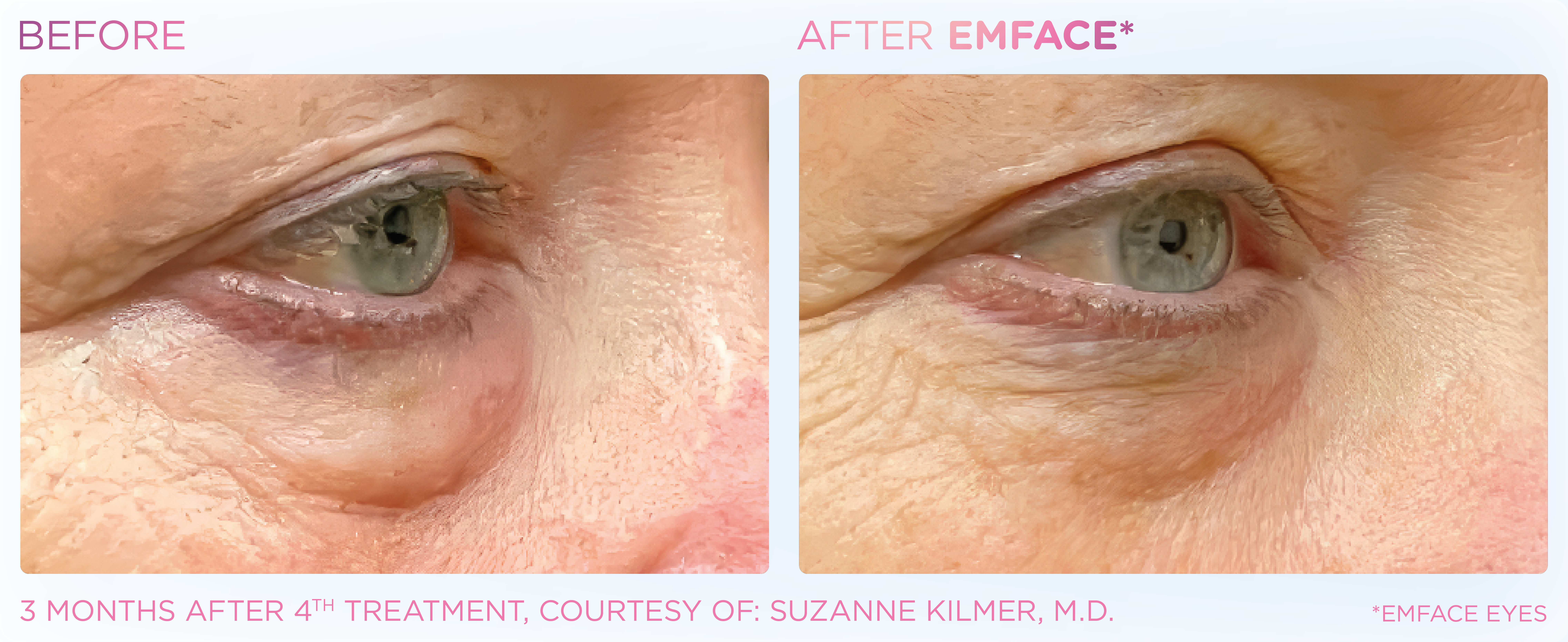 Under-Eye Treatment, manufacturer before-and-after example 9; before on the left and after on the right