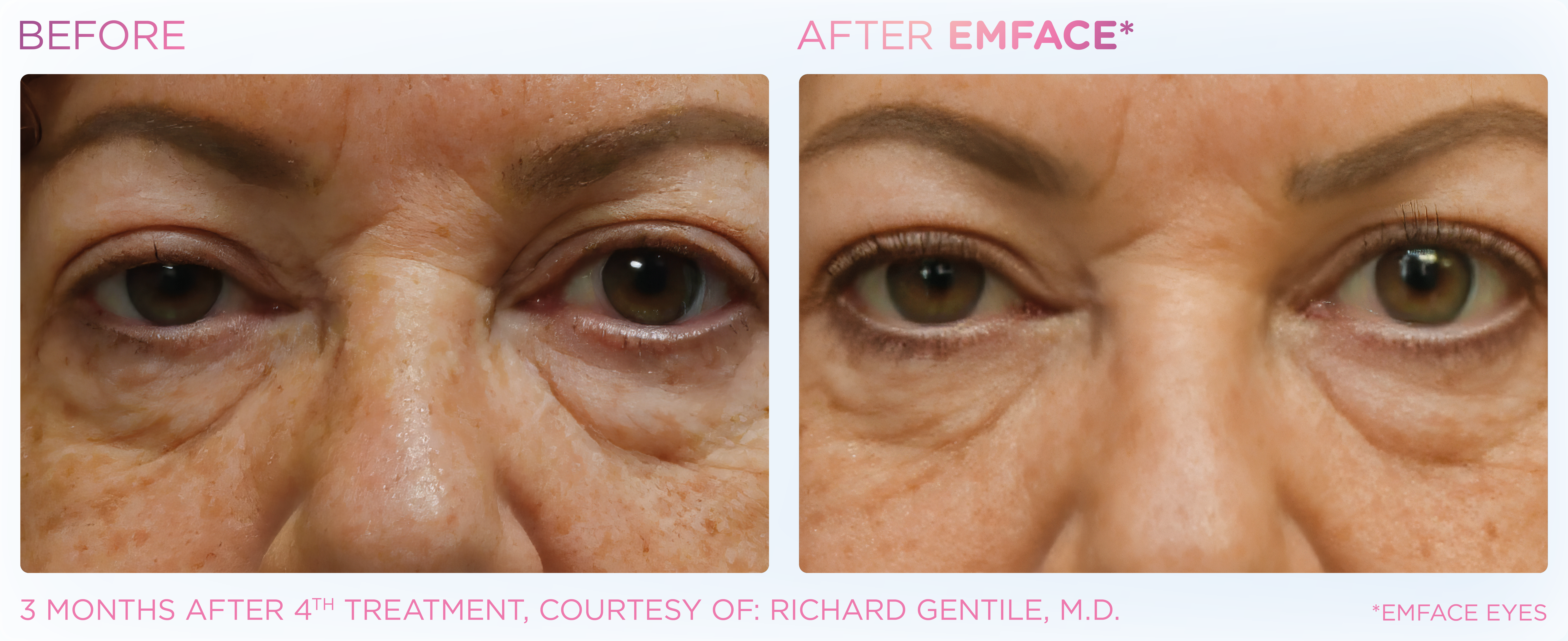 Under-Eye Treatment, manufacturer before-and-after example 10; before on the left and after on the right