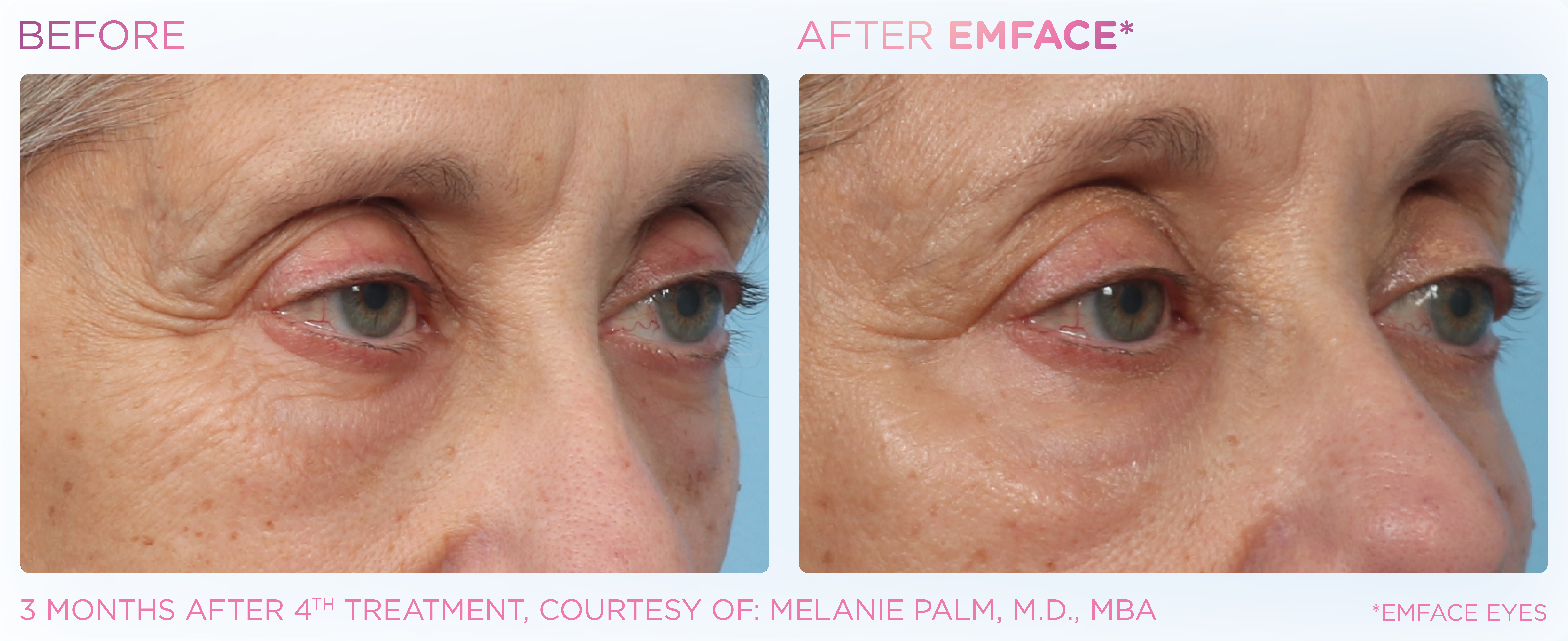 Under-Eye Treatment, manufacturer before-and-after example 11; before on the left and after on the right