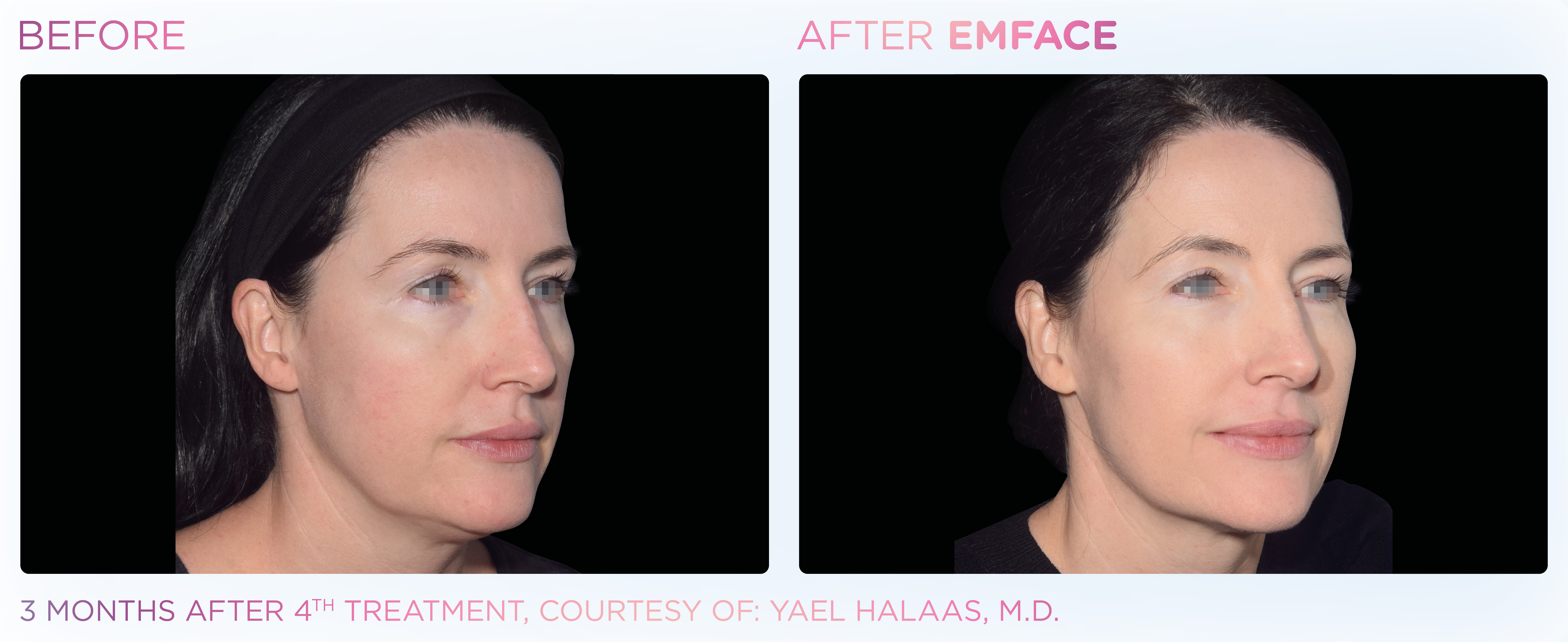 Facial Rejuvenation, manufacturer before-and-after example 1; before on the left and after on the right