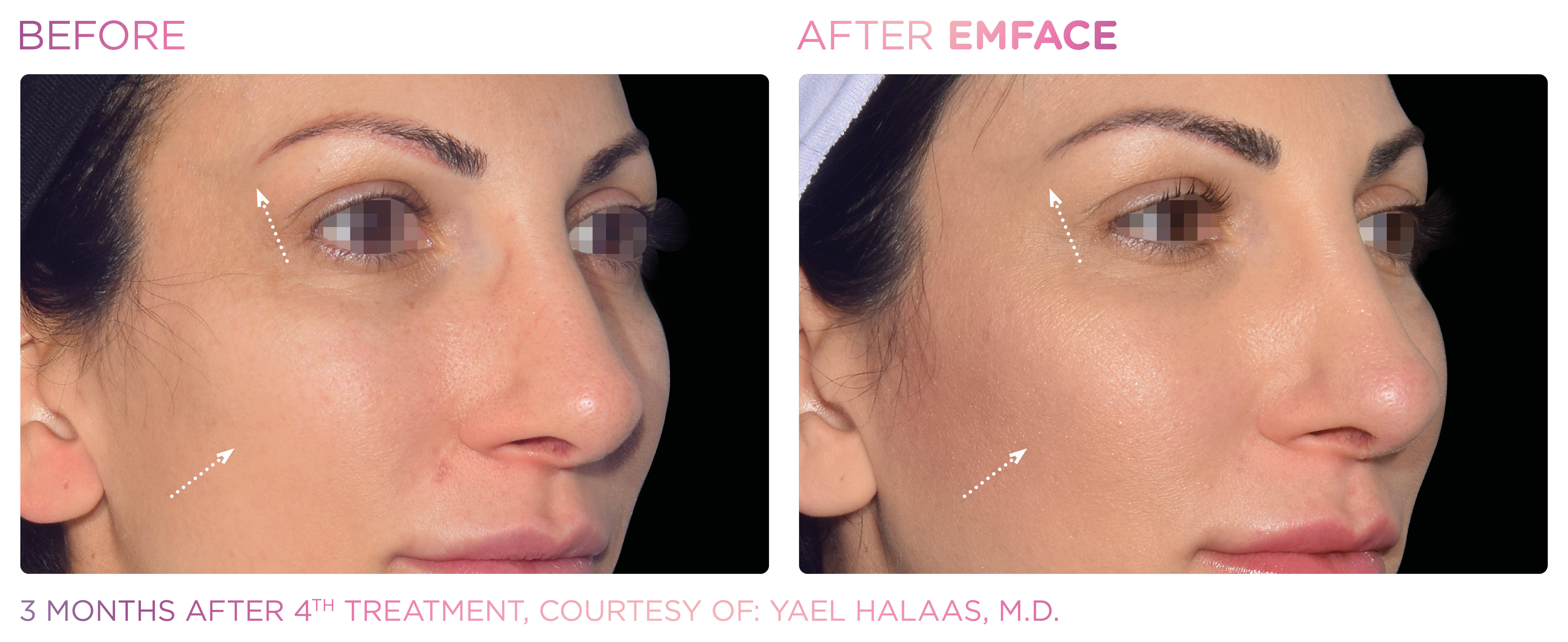 Facial Rejuvenation, manufacturer before-and-after example 2; before on the left and after on the right