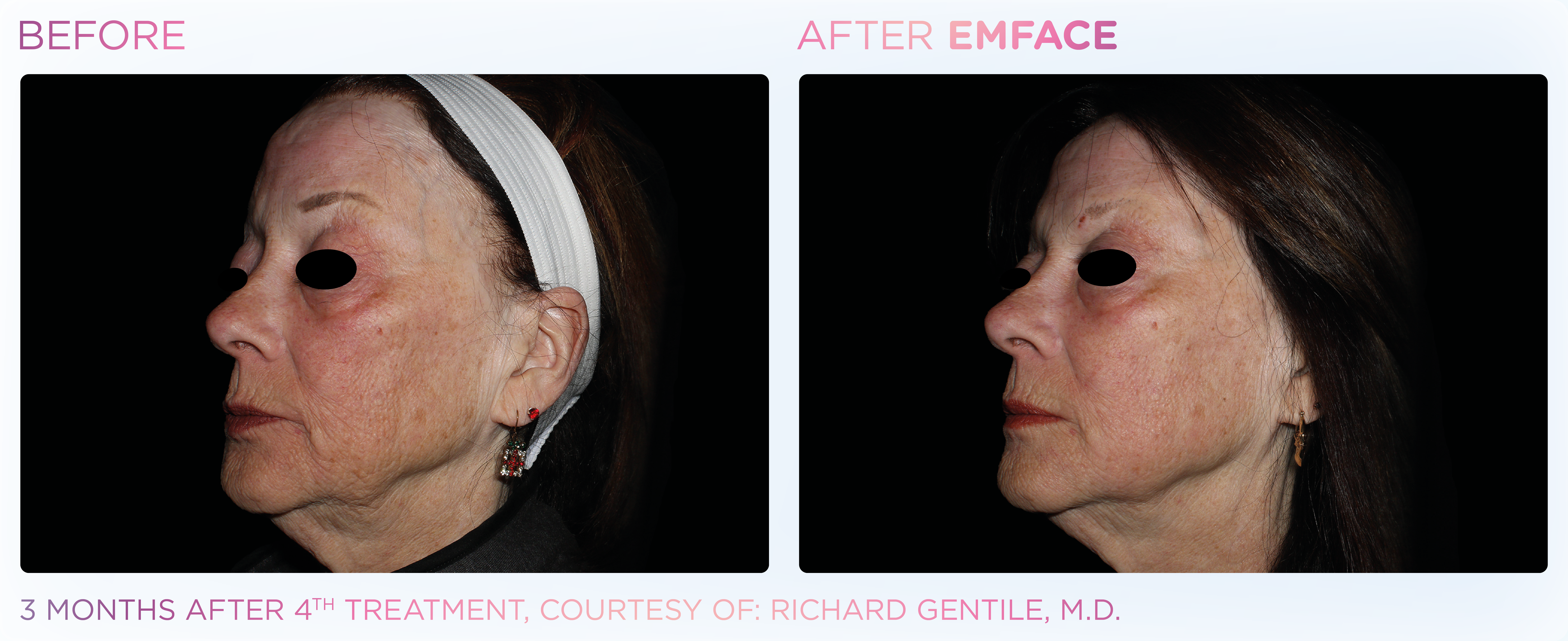 Facial Rejuvenation, manufacturer before-and-after example 3; before on the left and after on the right