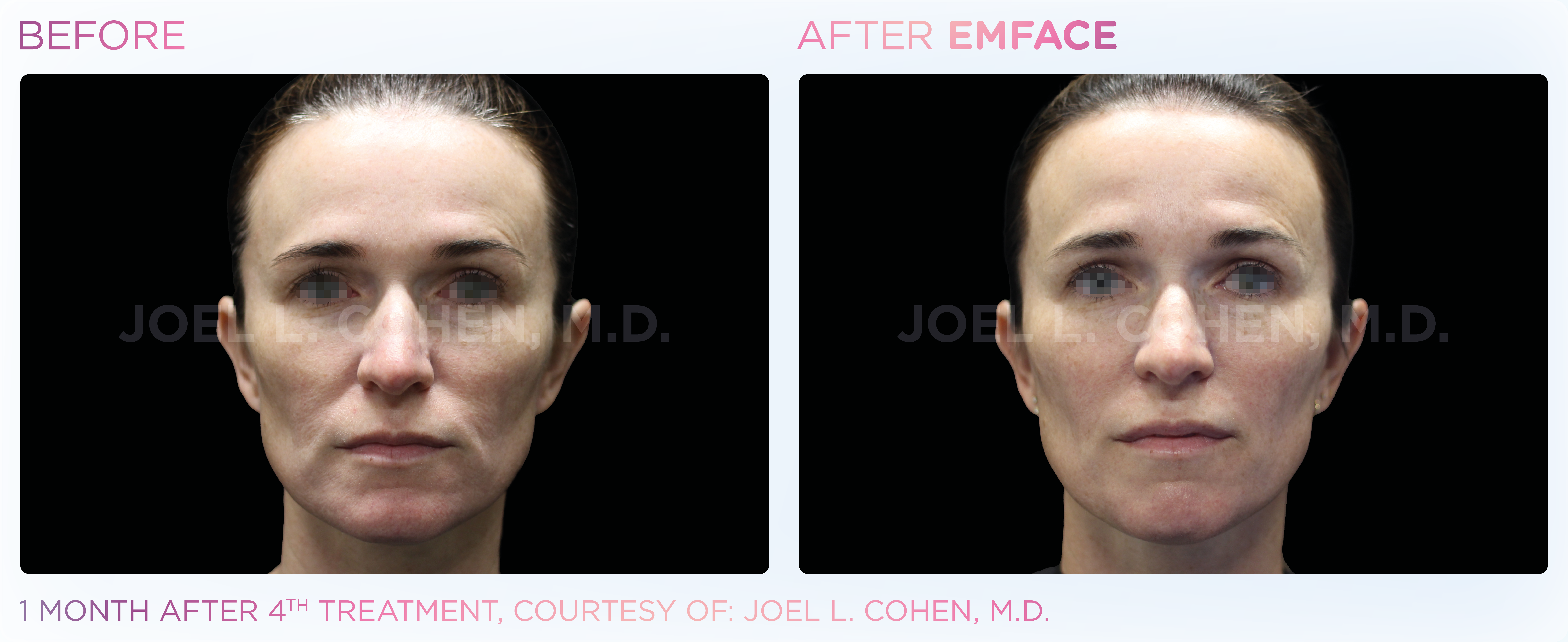 Facial Rejuvenation, manufacturer before-and-after example 4; before on the left and after on the right