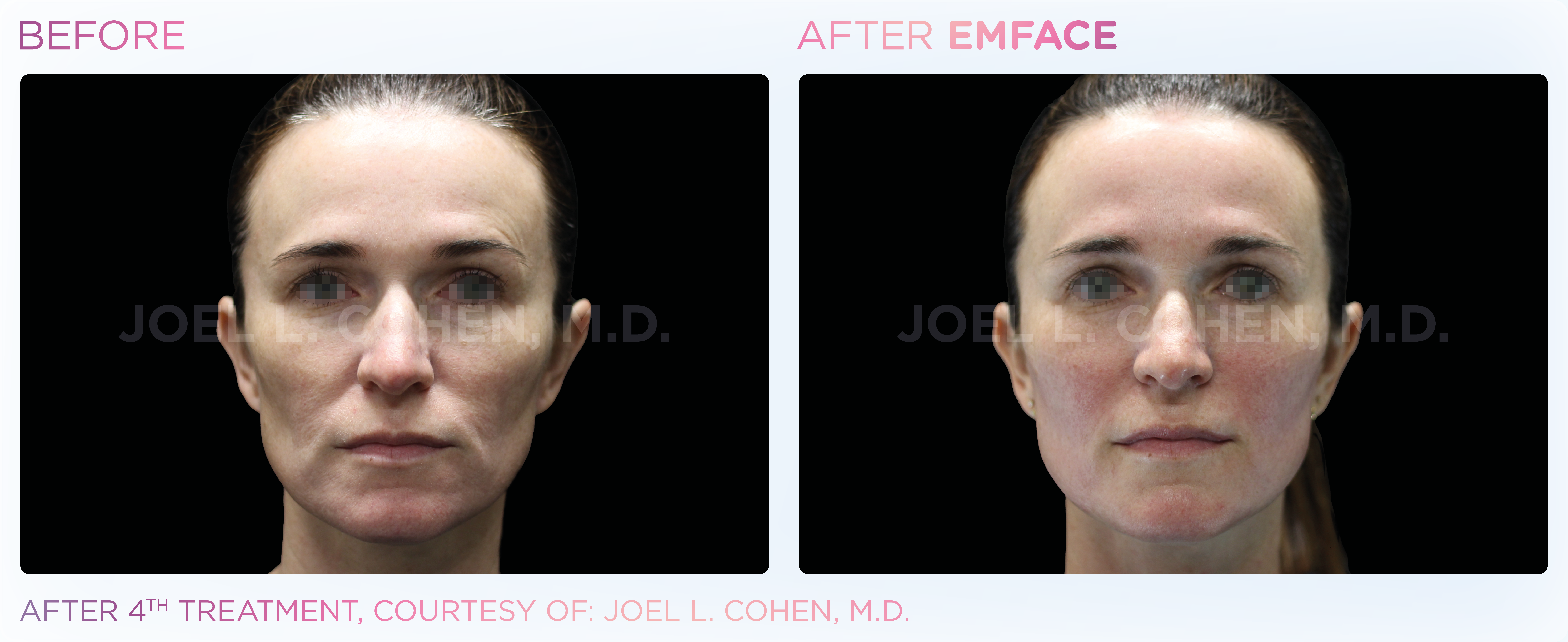 Facial Rejuvenation, manufacturer before-and-after example 5; before on the left and after on the right