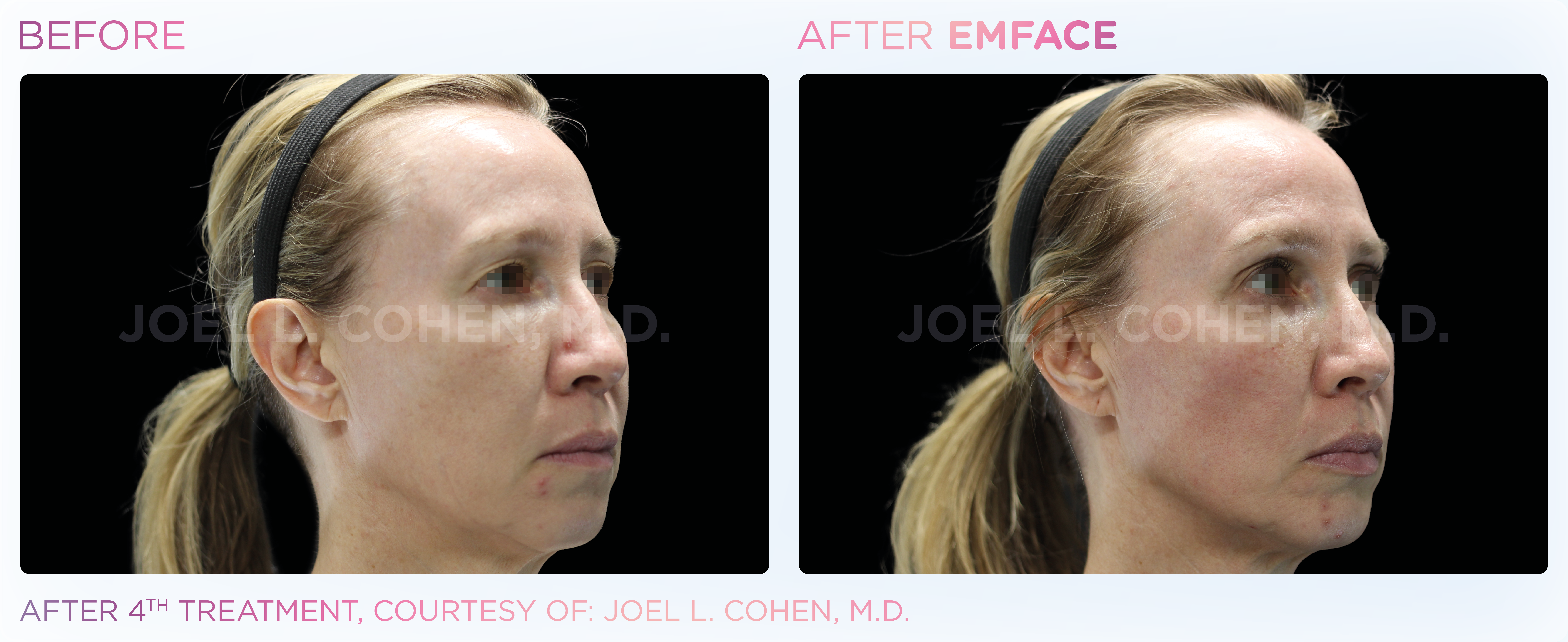 Facial Rejuvenation, manufacturer before-and-after example 6; before on the left and after on the right