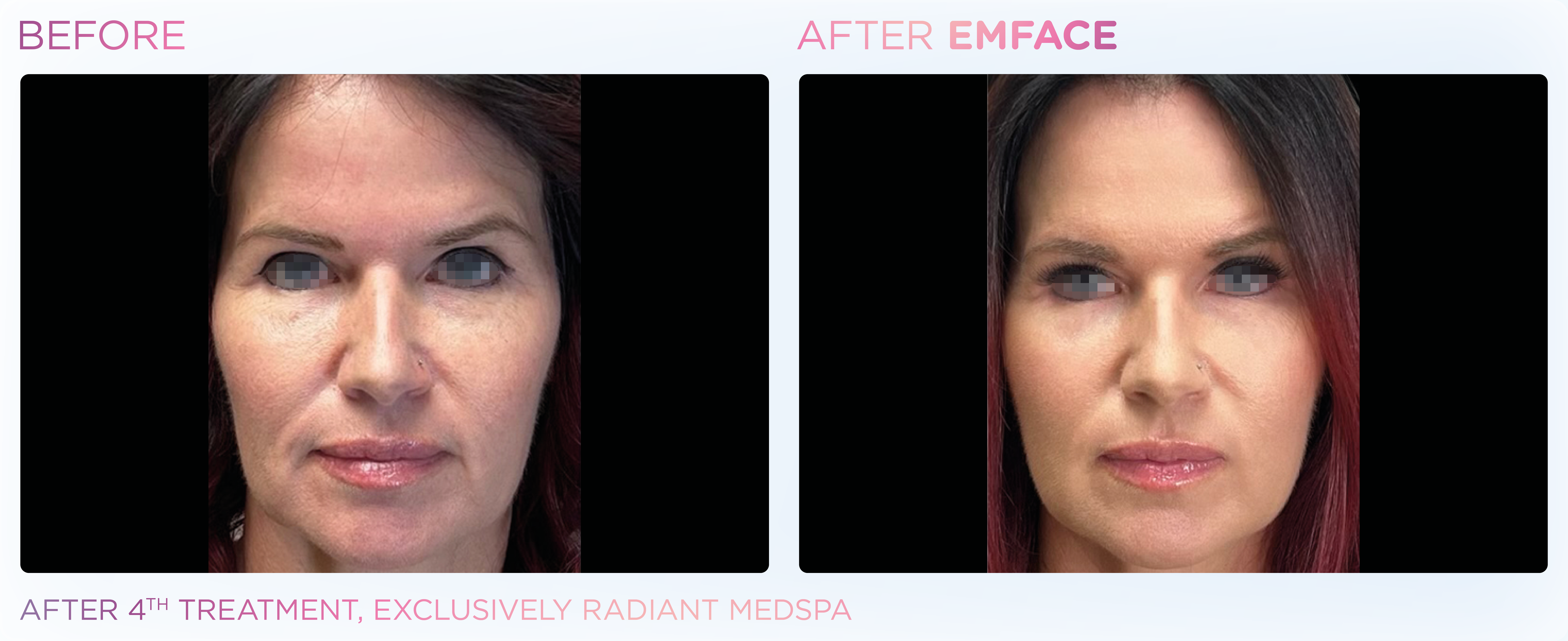 Facial Rejuvenation, manufacturer before-and-after example 7; before on the left and after on the right