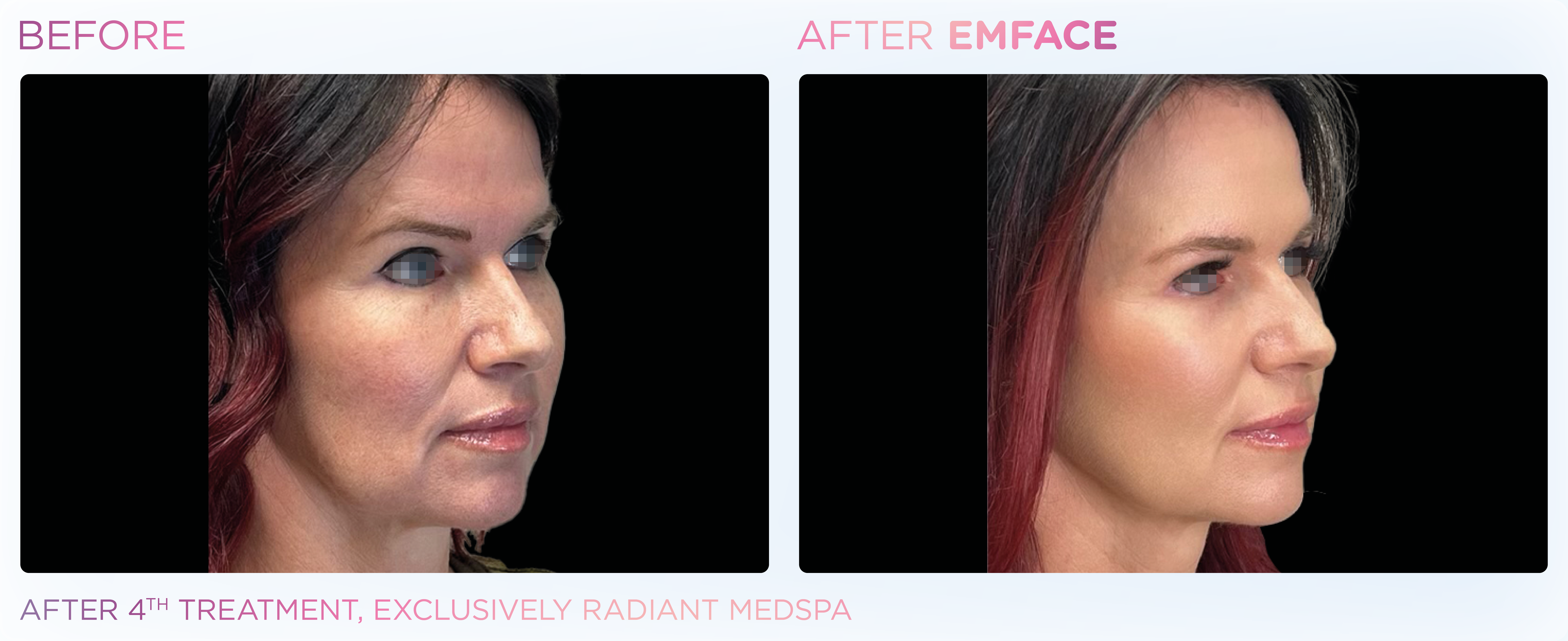 Facial Rejuvenation, manufacturer before-and-after example 8; before on the left and after on the right