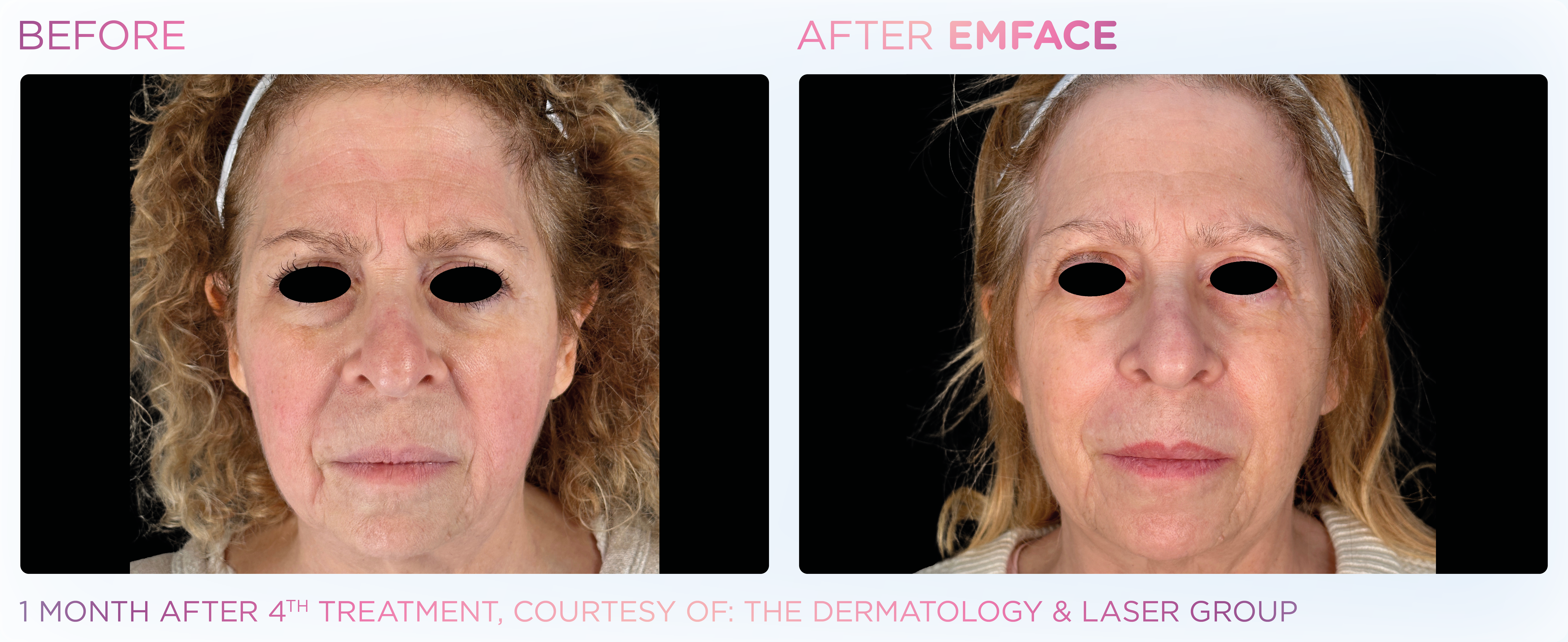 Facial Rejuvenation, manufacturer before-and-after example 9; before on the left and after on the right