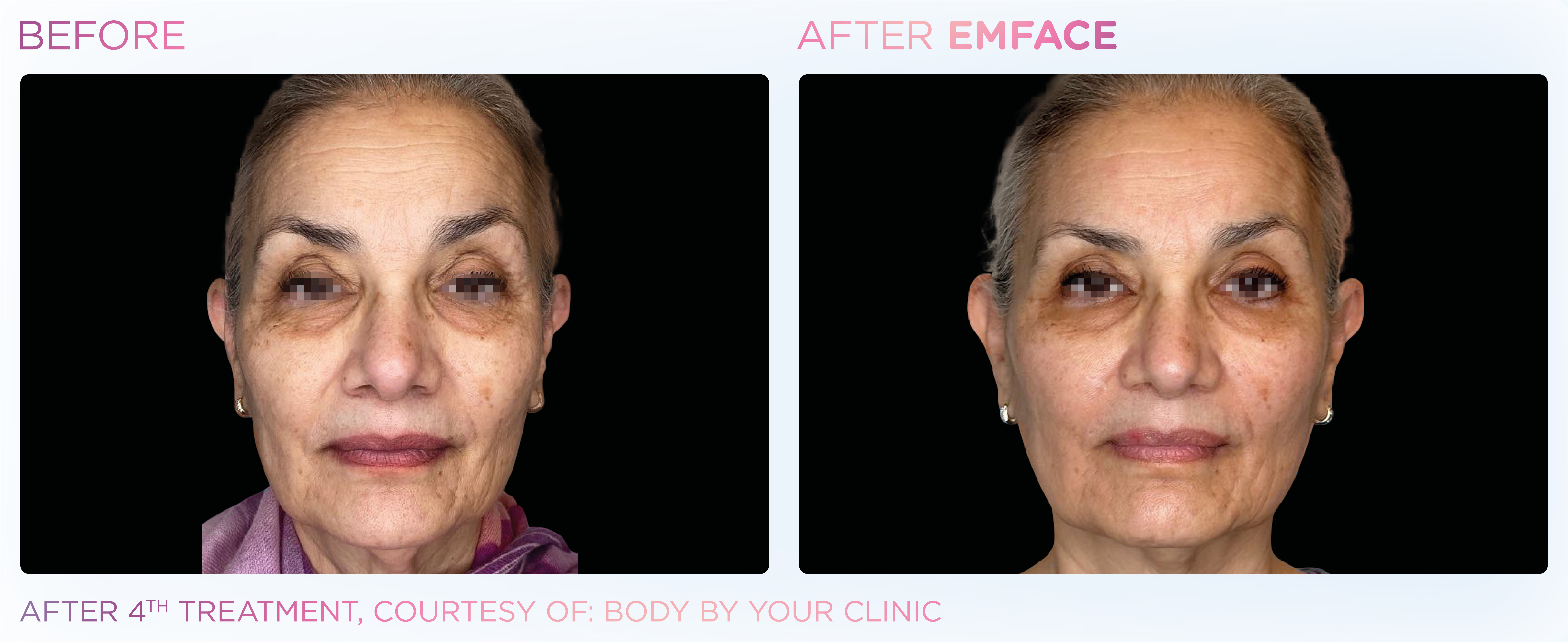 Facial Rejuvenation, manufacturer before-and-after example 10; before on the left and after on the right