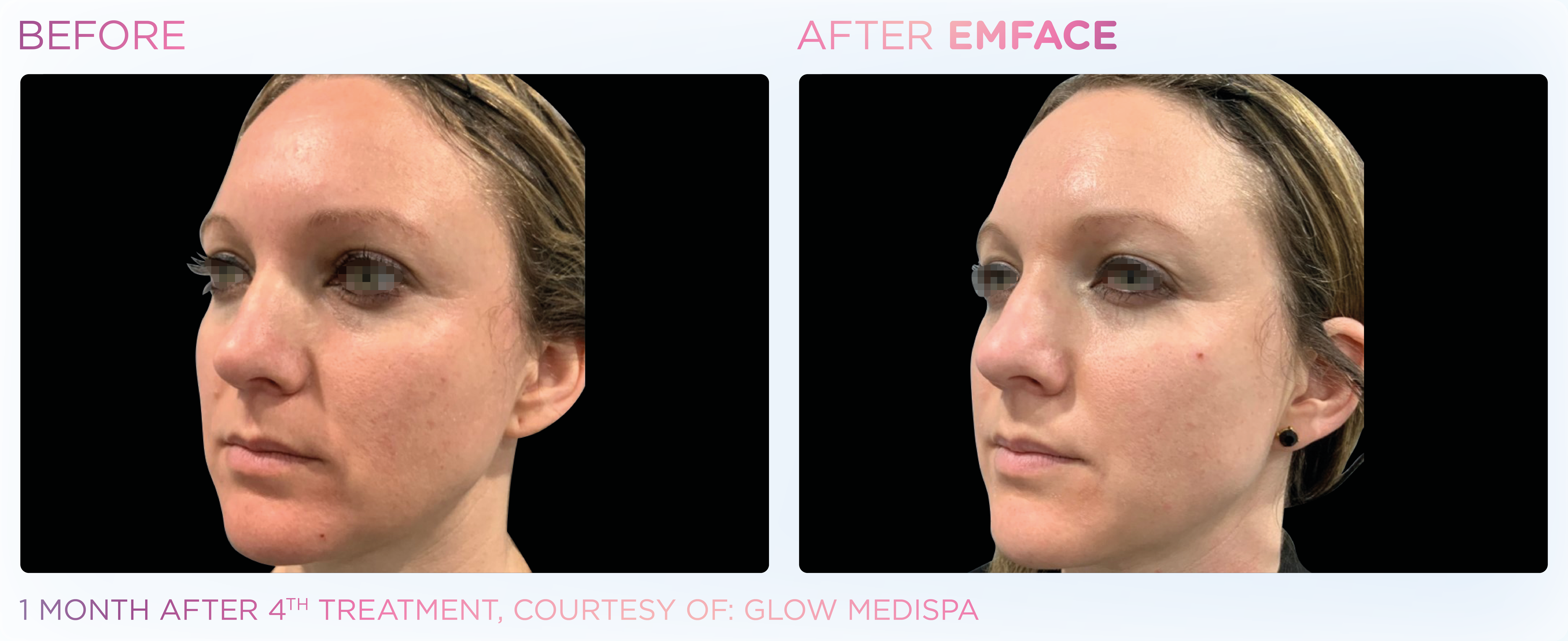Facial Rejuvenation, manufacturer before-and-after example 11; before on the left and after on the right