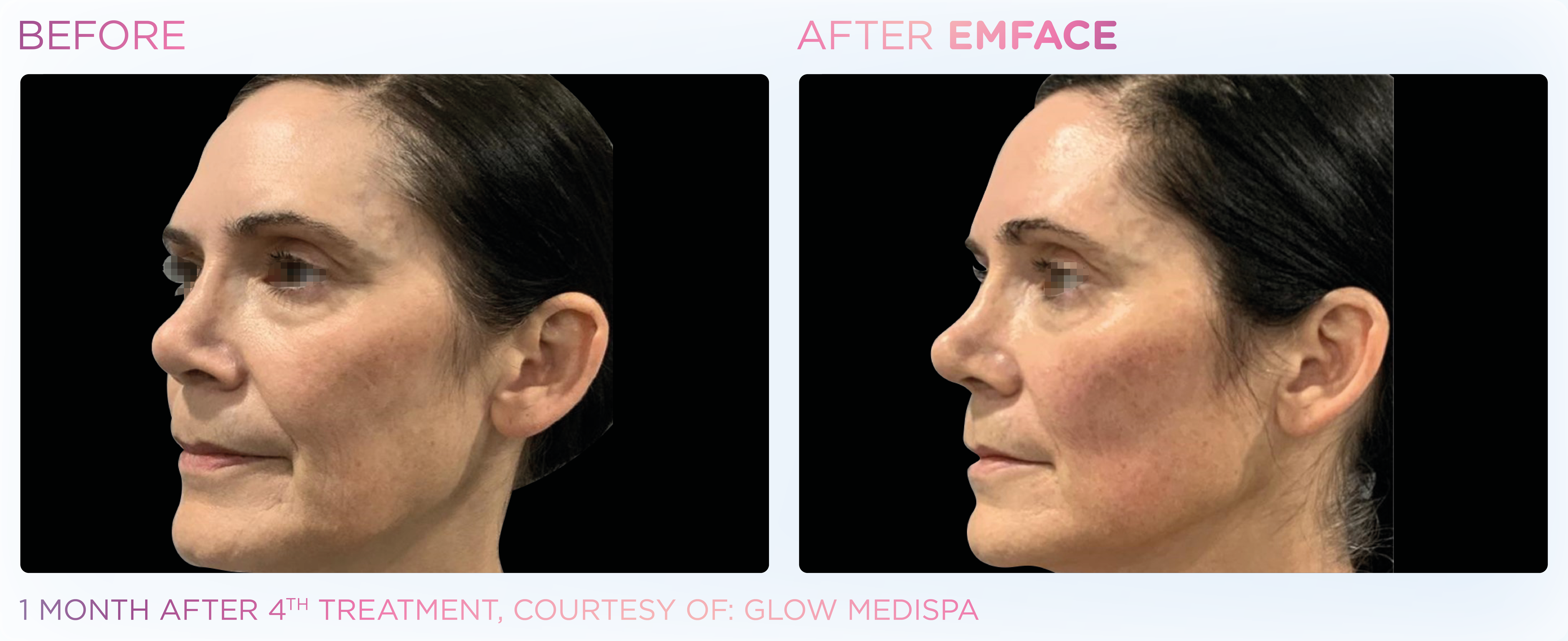 Facial Rejuvenation, manufacturer before-and-after example 12; before on the left and after on the right