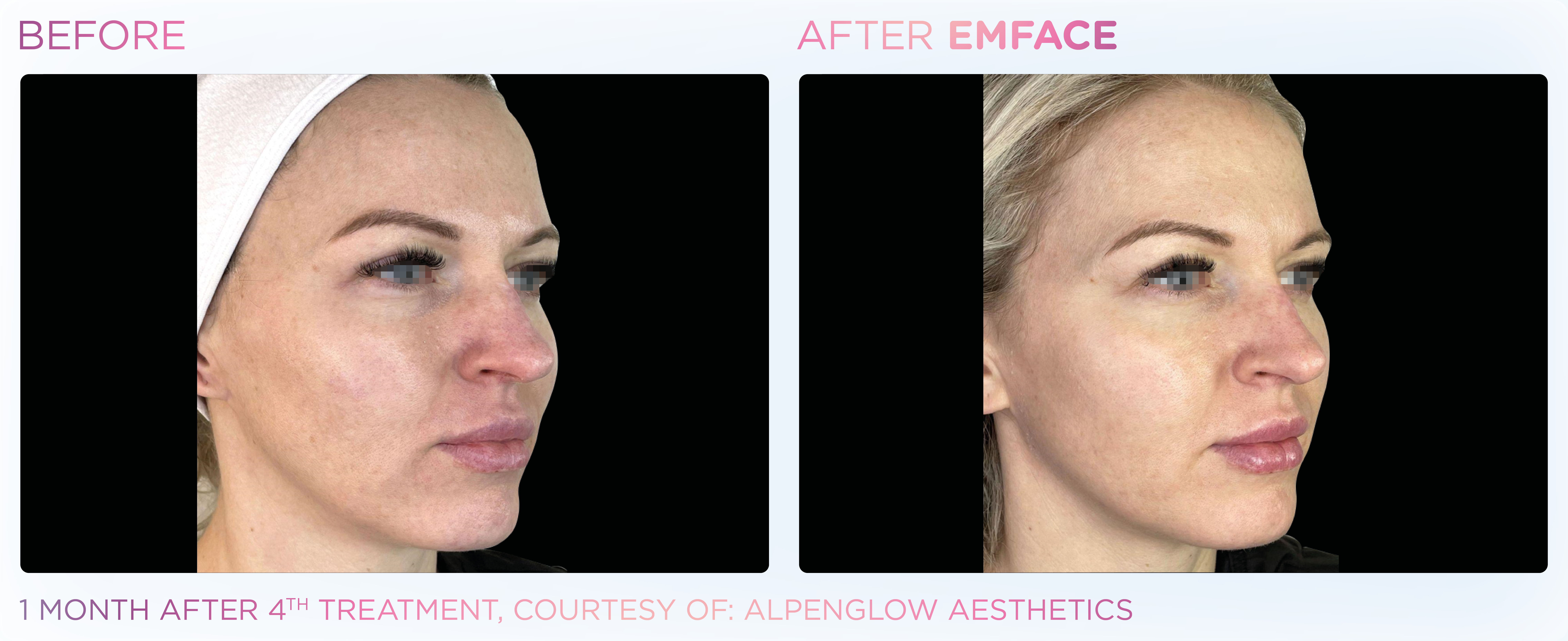 Facial Rejuvenation, manufacturer before-and-after example 13; before on the left and after on the right