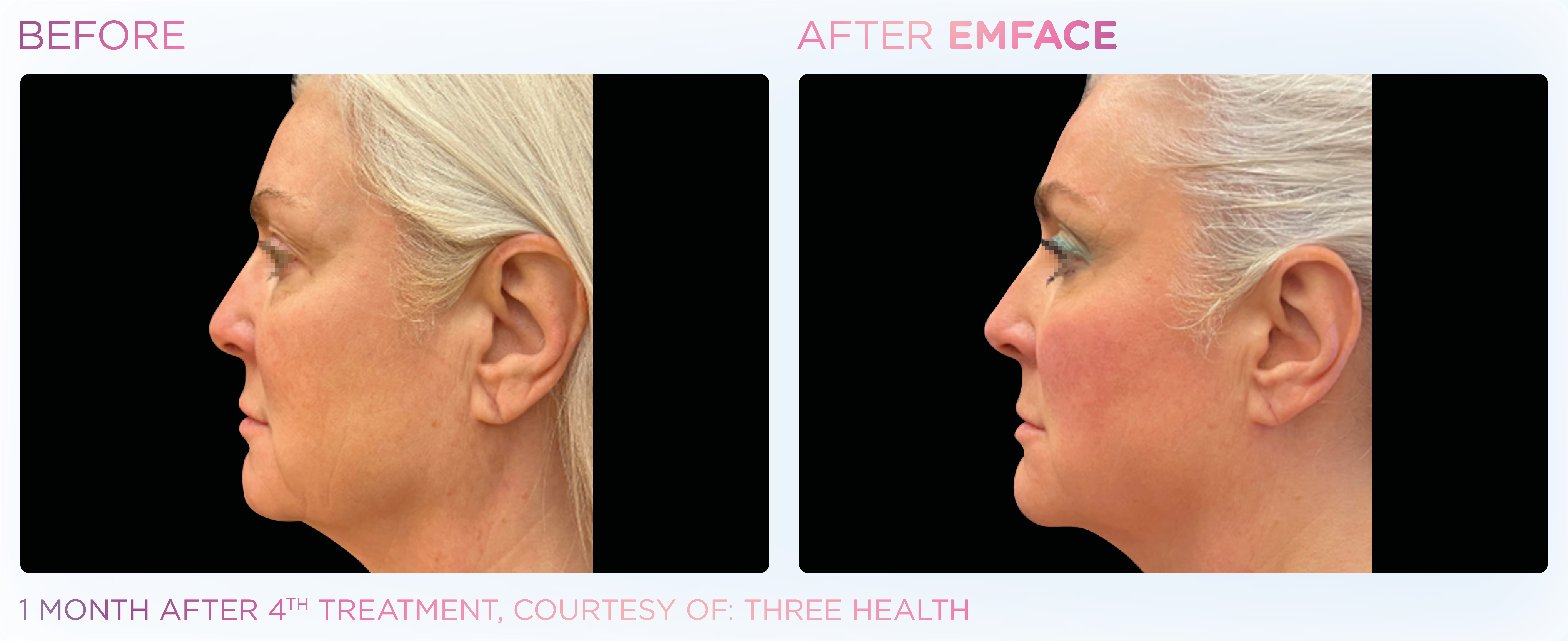 Facial Rejuvenation, manufacturer before-and-after example 14; before on the left and after on the right