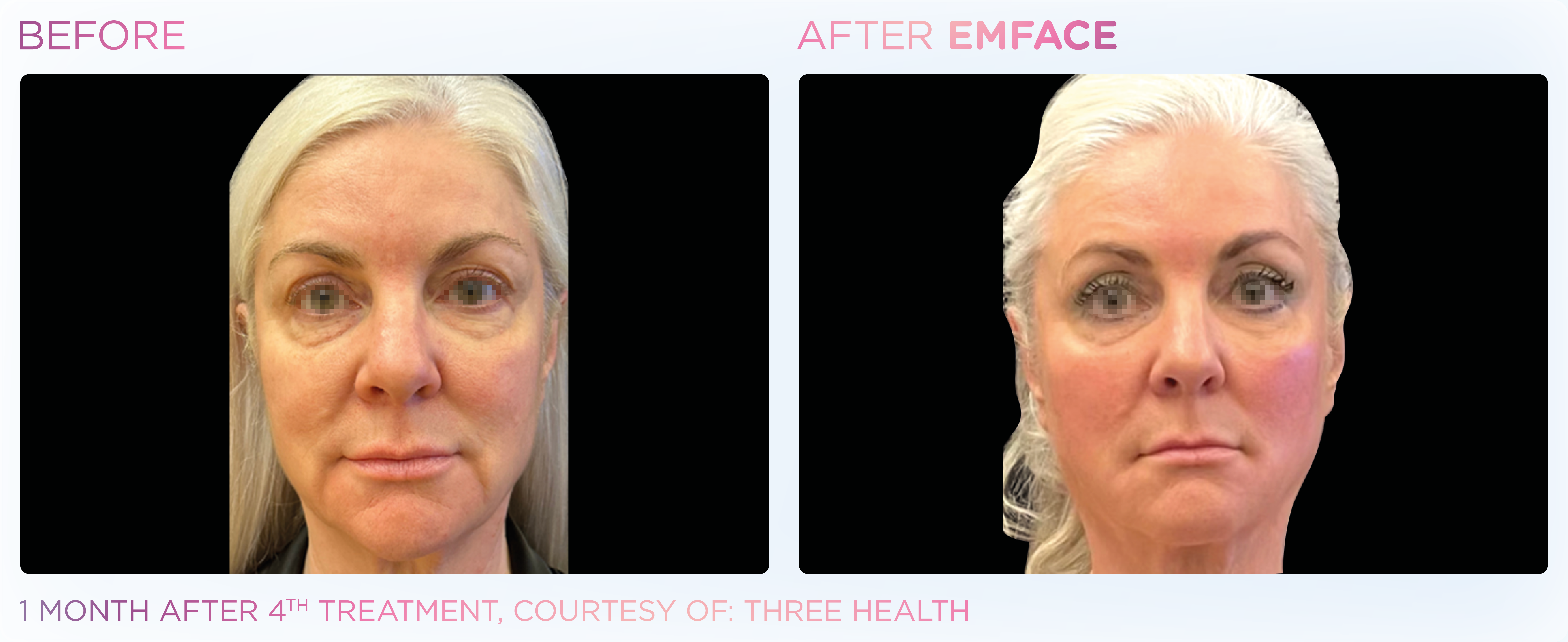 Facial Rejuvenation, manufacturer before-and-after example 15; before on the left and after on the right