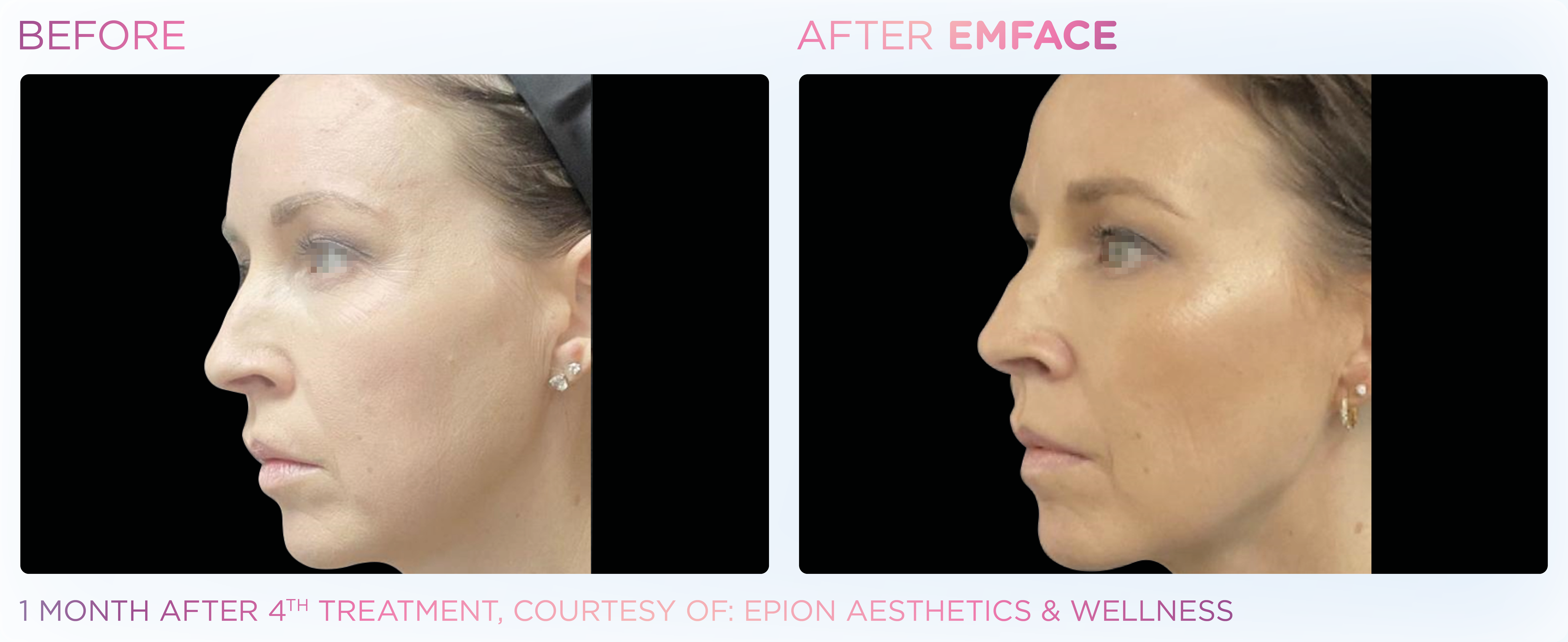 Facial Rejuvenation, manufacturer before-and-after example 16; before on the left and after on the right