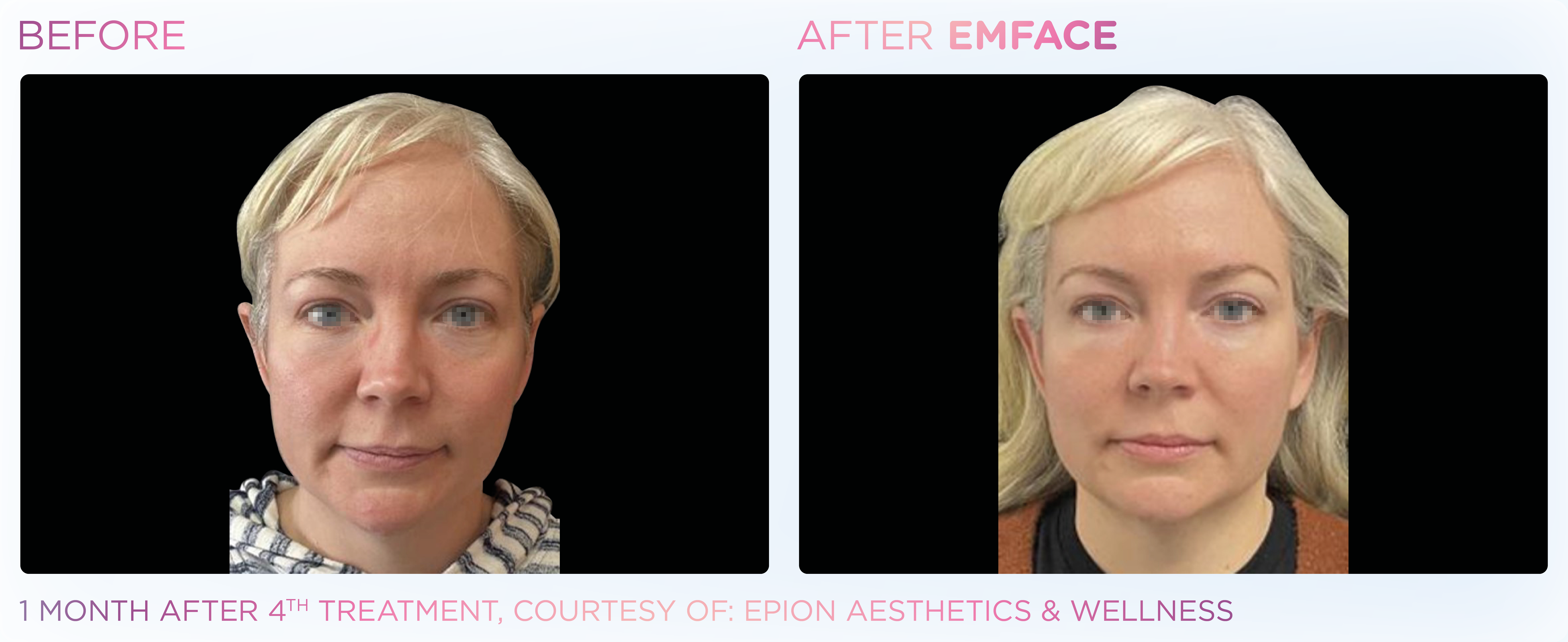 Facial Rejuvenation, manufacturer before-and-after example 17; before on the left and after on the right