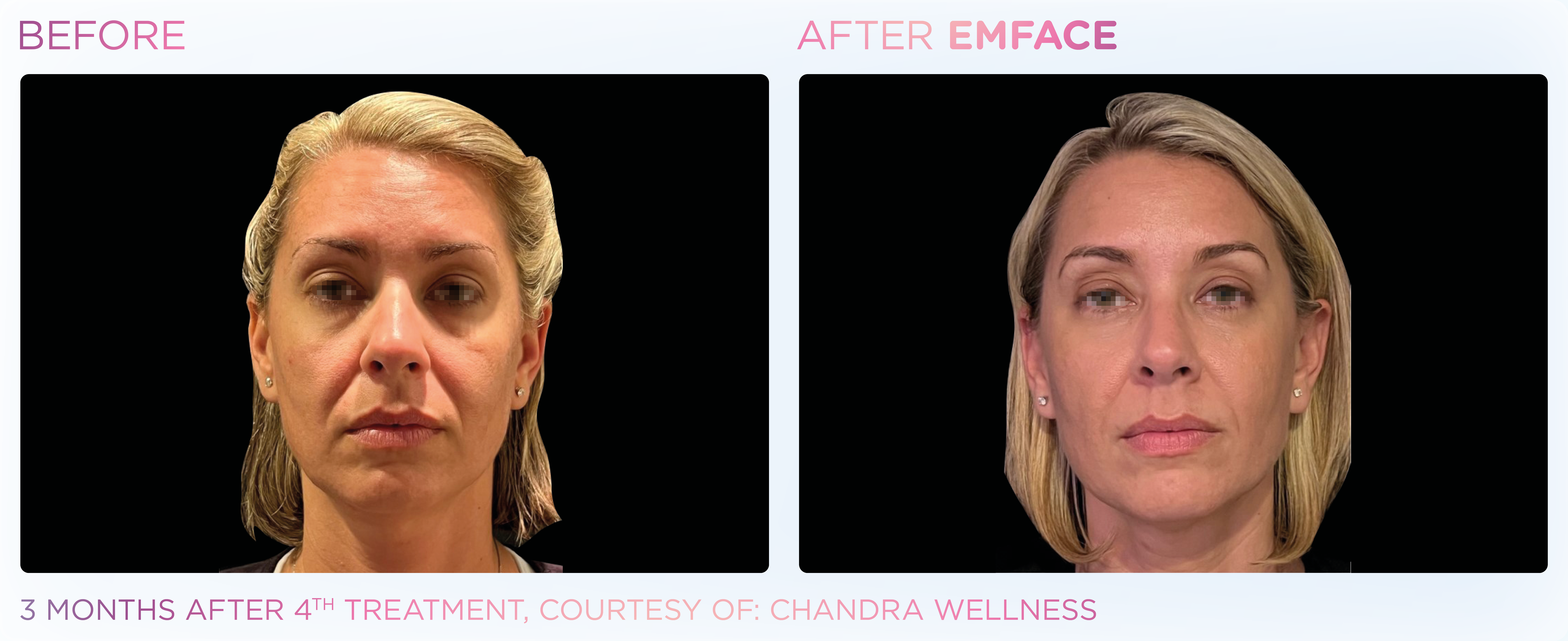 Facial Rejuvenation, manufacturer before-and-after example 18; before on the left and after on the right