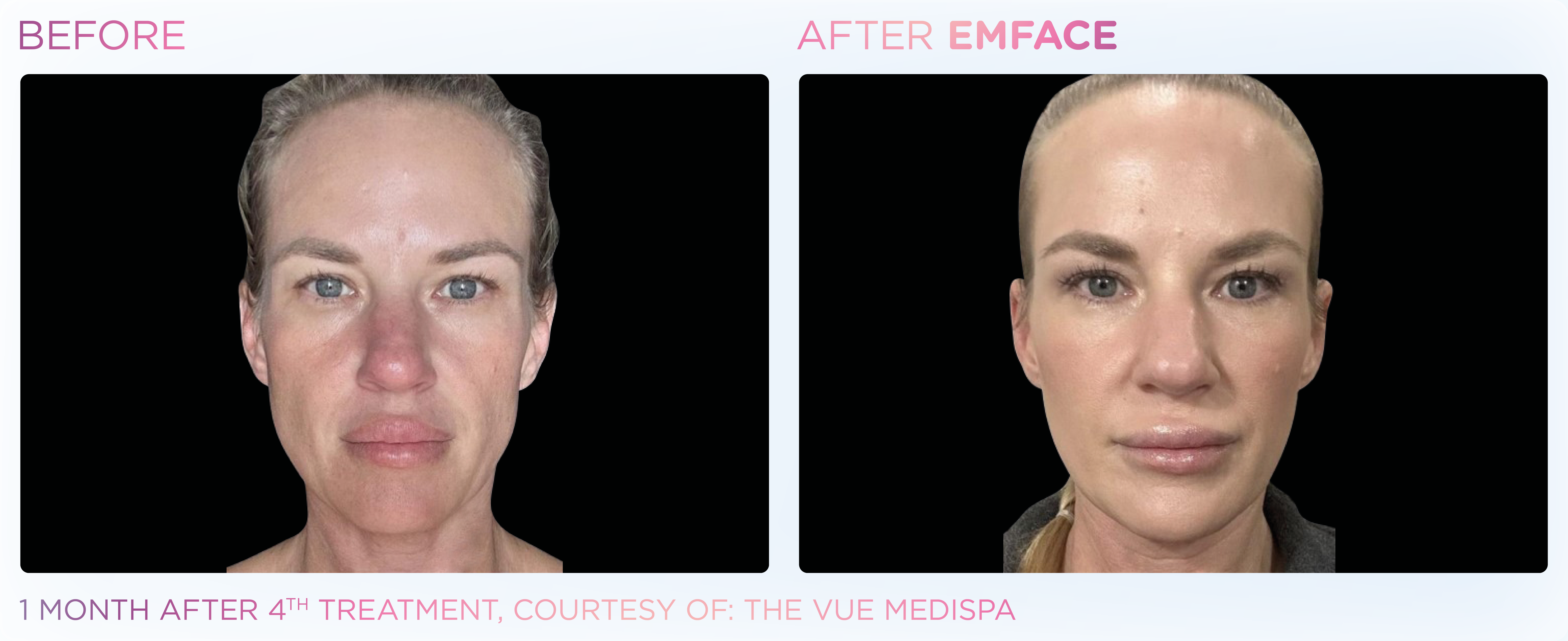 Facial Rejuvenation, manufacturer before-and-after example 19; before on the left and after on the right