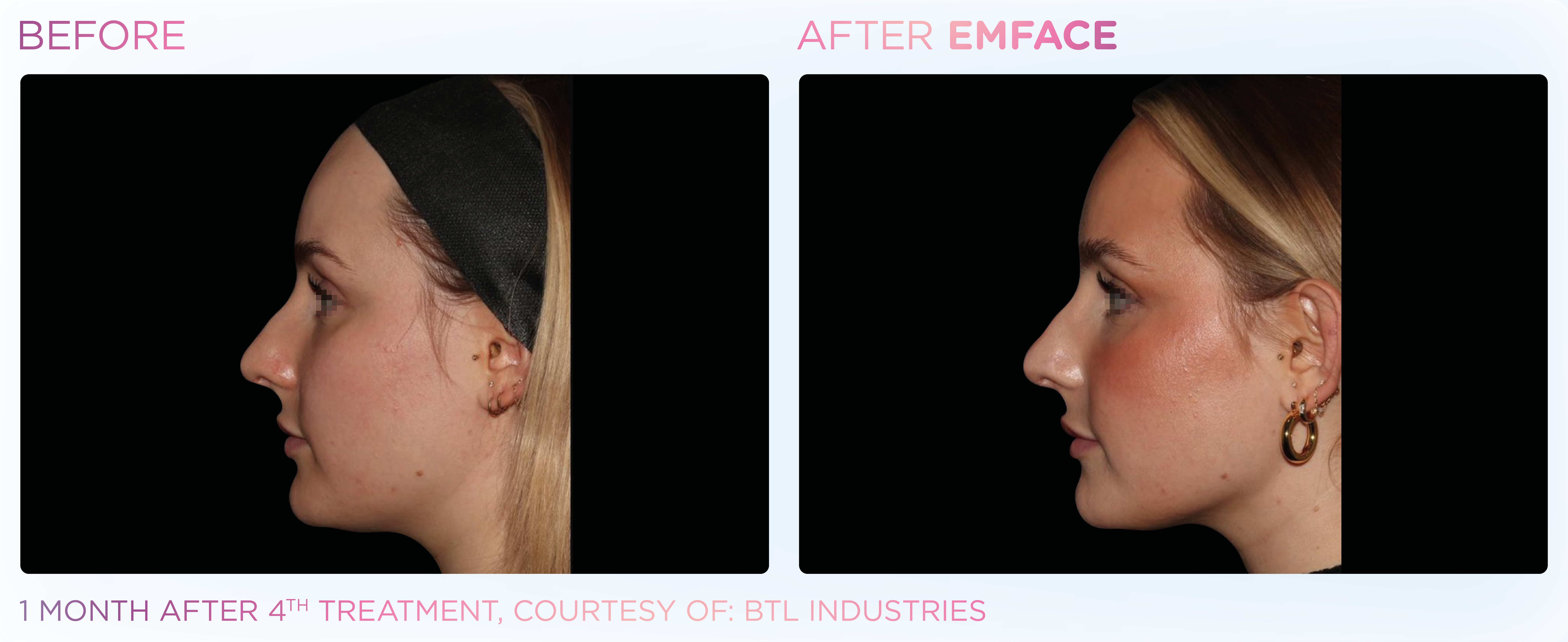 Facial Rejuvenation, manufacturer before-and-after example 20; before on the left and after on the right