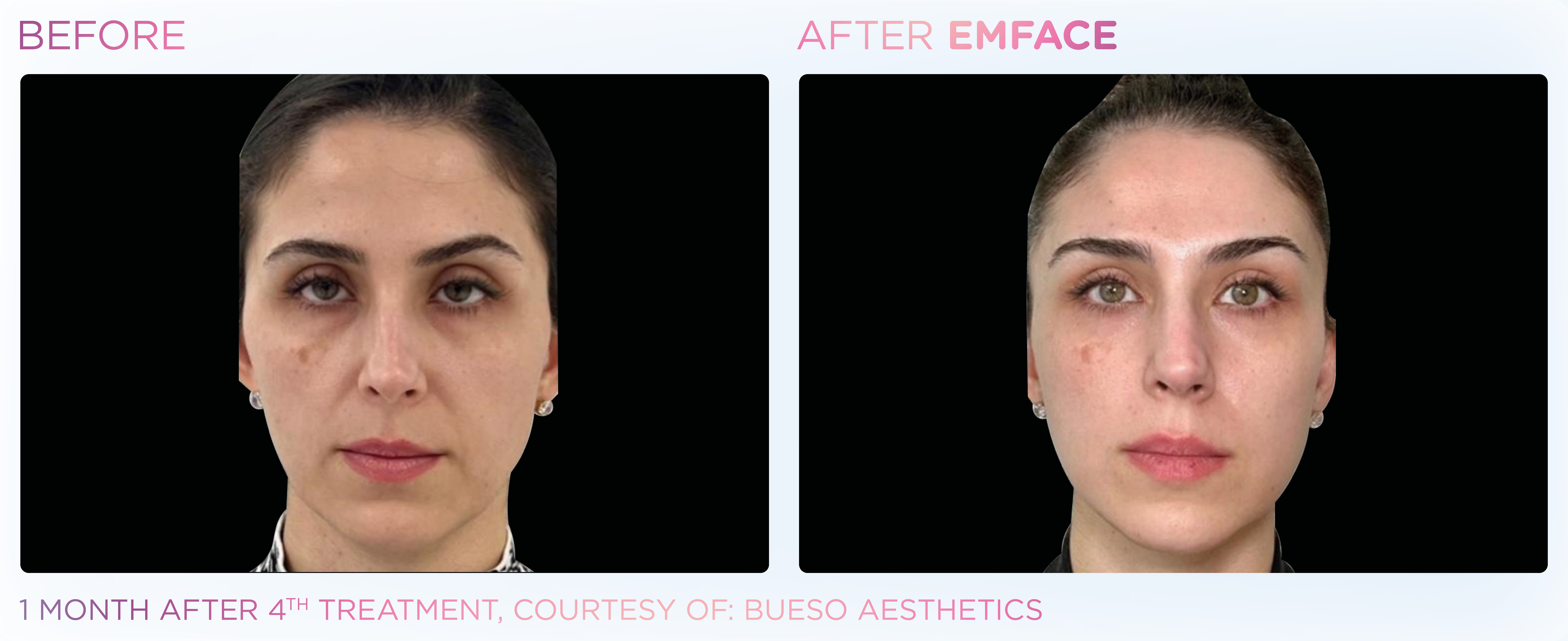 Facial Rejuvenation, manufacturer before-and-after example 21; before on the left and after on the right