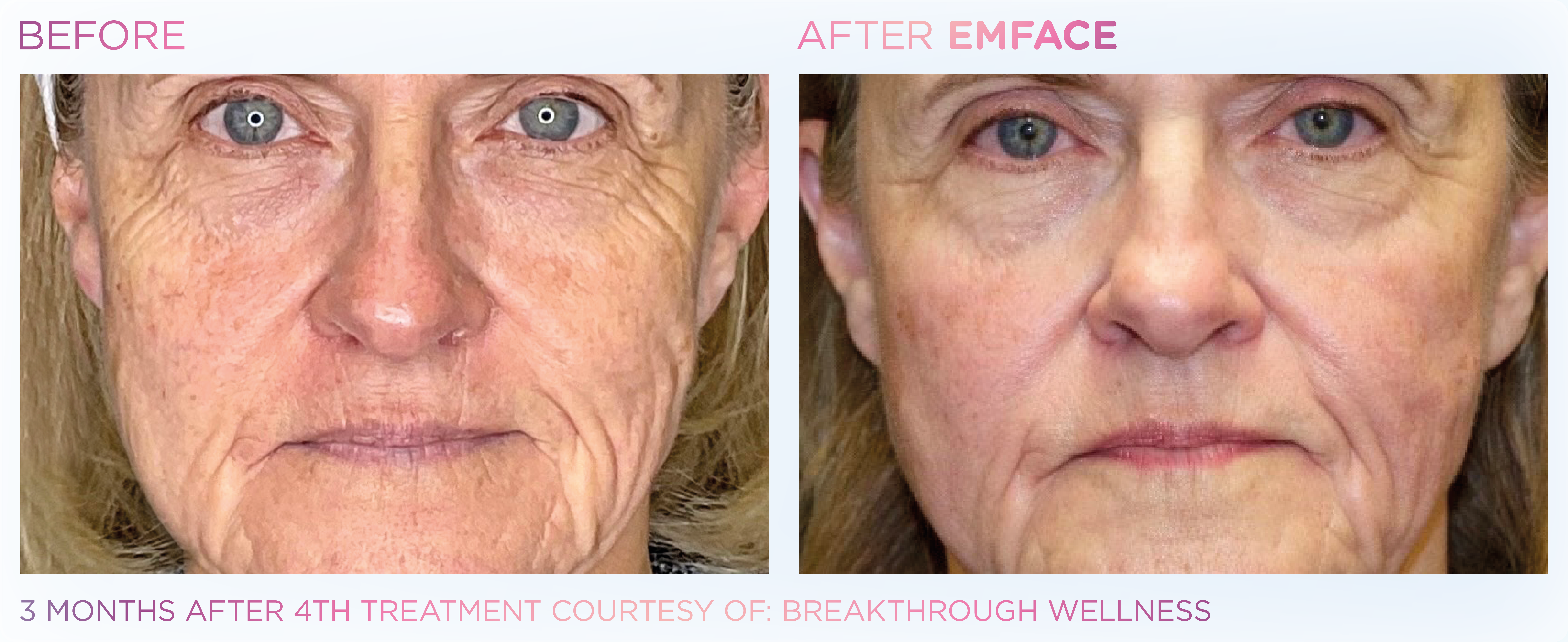 Facial Rejuvenation, manufacturer before-and-after example 22; before on the left and after on the right