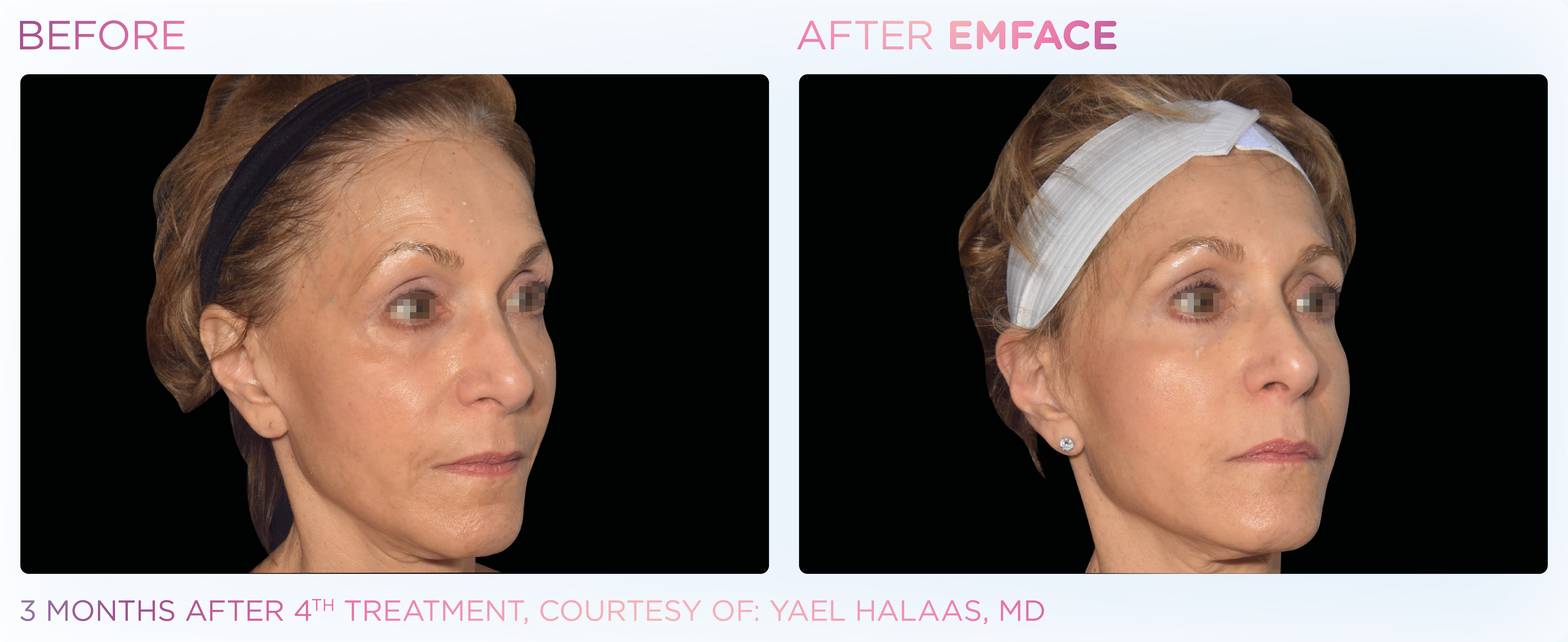 Facial Rejuvenation, manufacturer before-and-after example 23; before on the left and after on the right