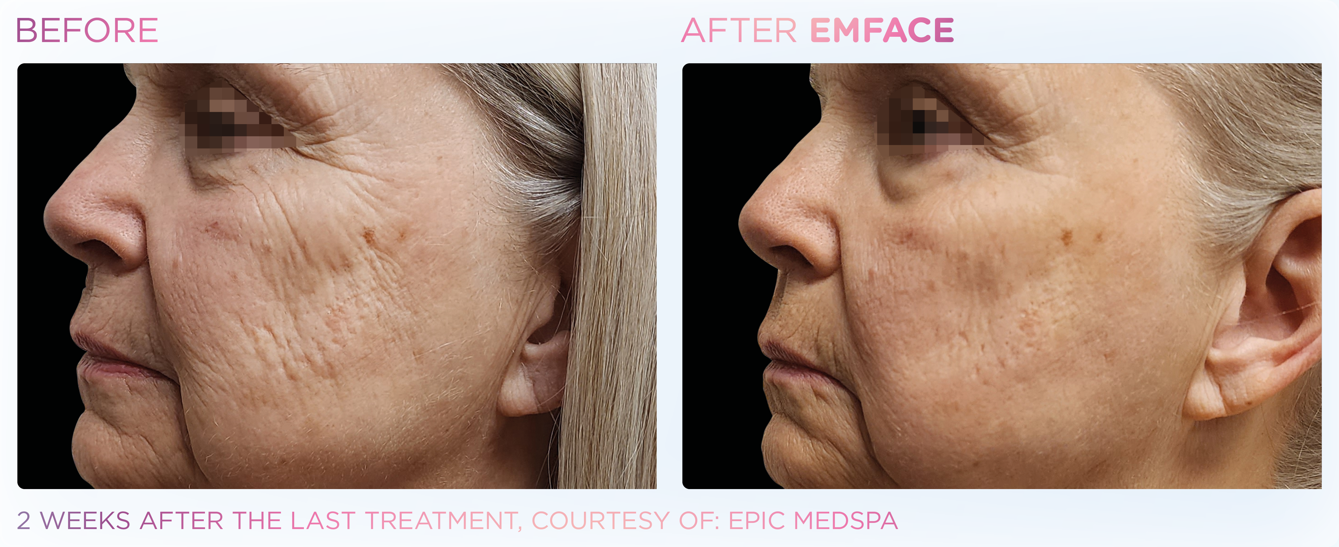 Facial Rejuvenation, manufacturer before-and-after example 24; before on the left and after on the right