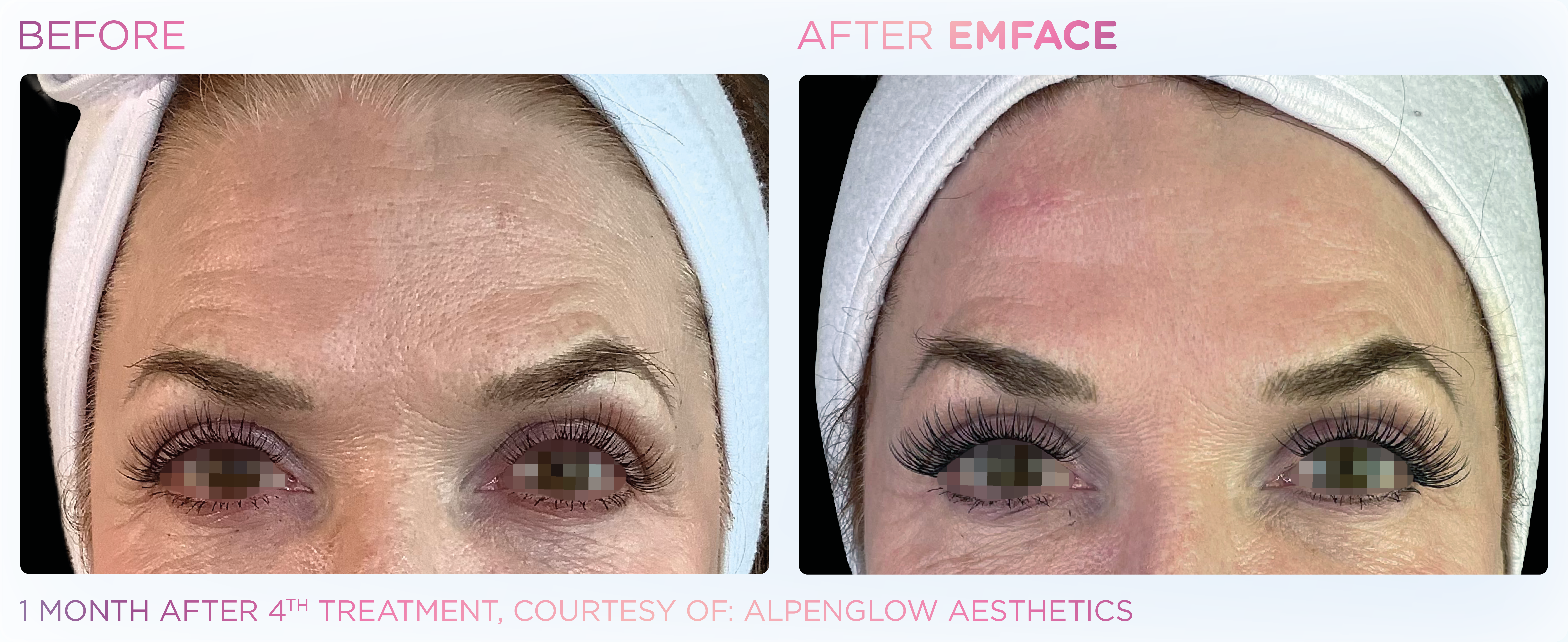Facial Rejuvenation, manufacturer before-and-after example 25; before on the left and after on the right