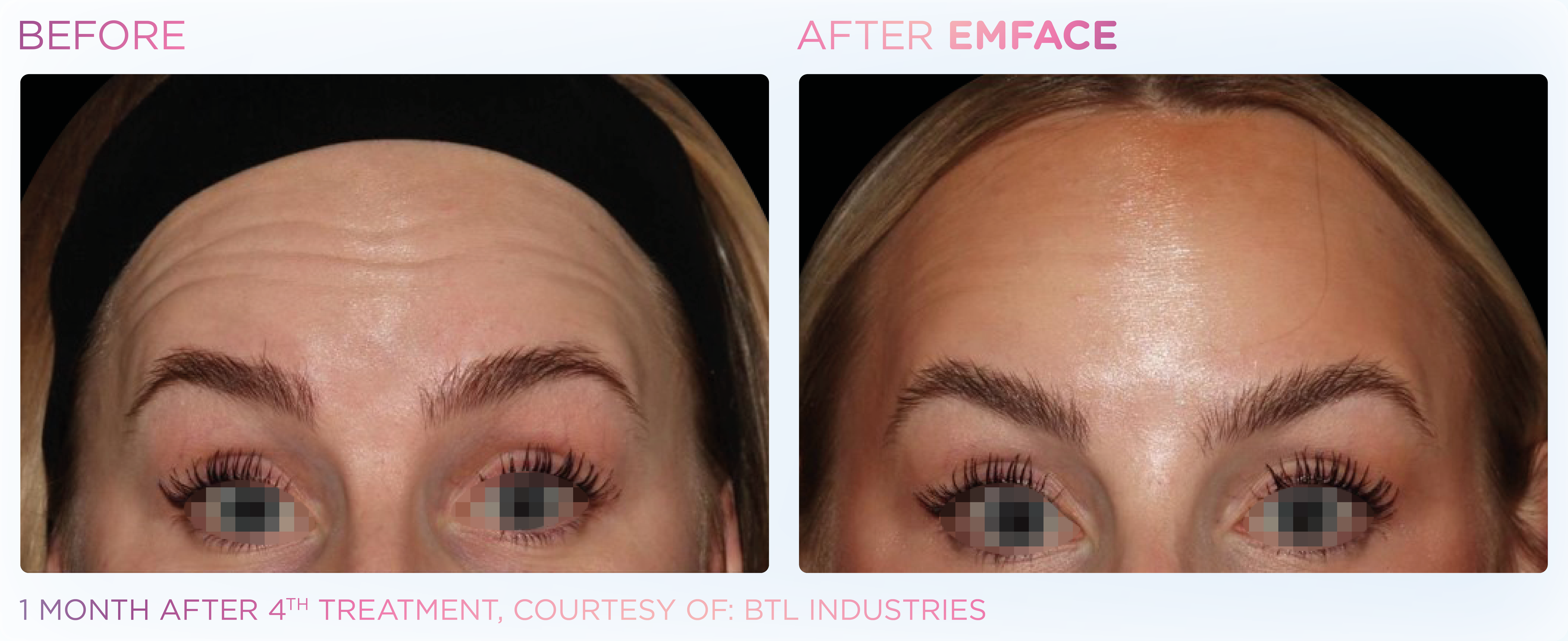 Facial Rejuvenation, manufacturer before-and-after example 26; before on the left and after on the right