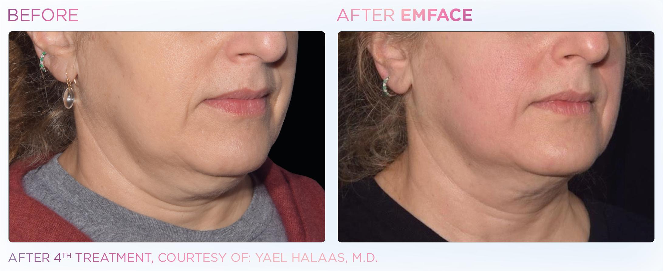 Jawline Contouring, manufacturer before-and-after example 1; before on the left and after on the right