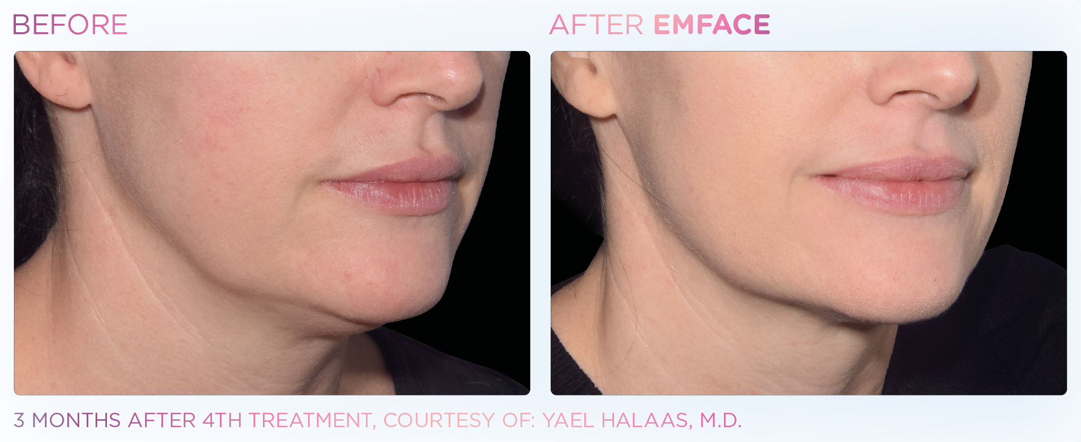 Jawline Contouring, manufacturer before-and-after example 2; before on the left and after on the right