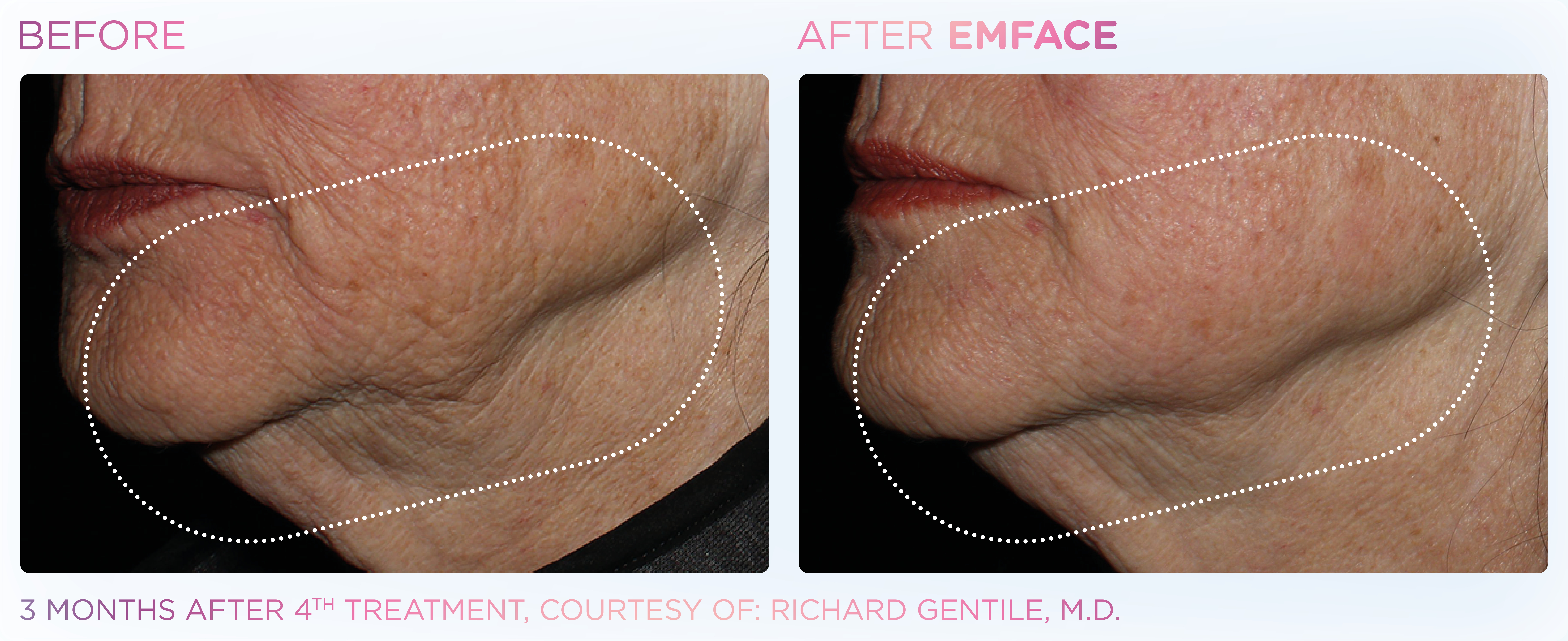 Jawline Contouring, manufacturer before-and-after example 3; before on the left and after on the right