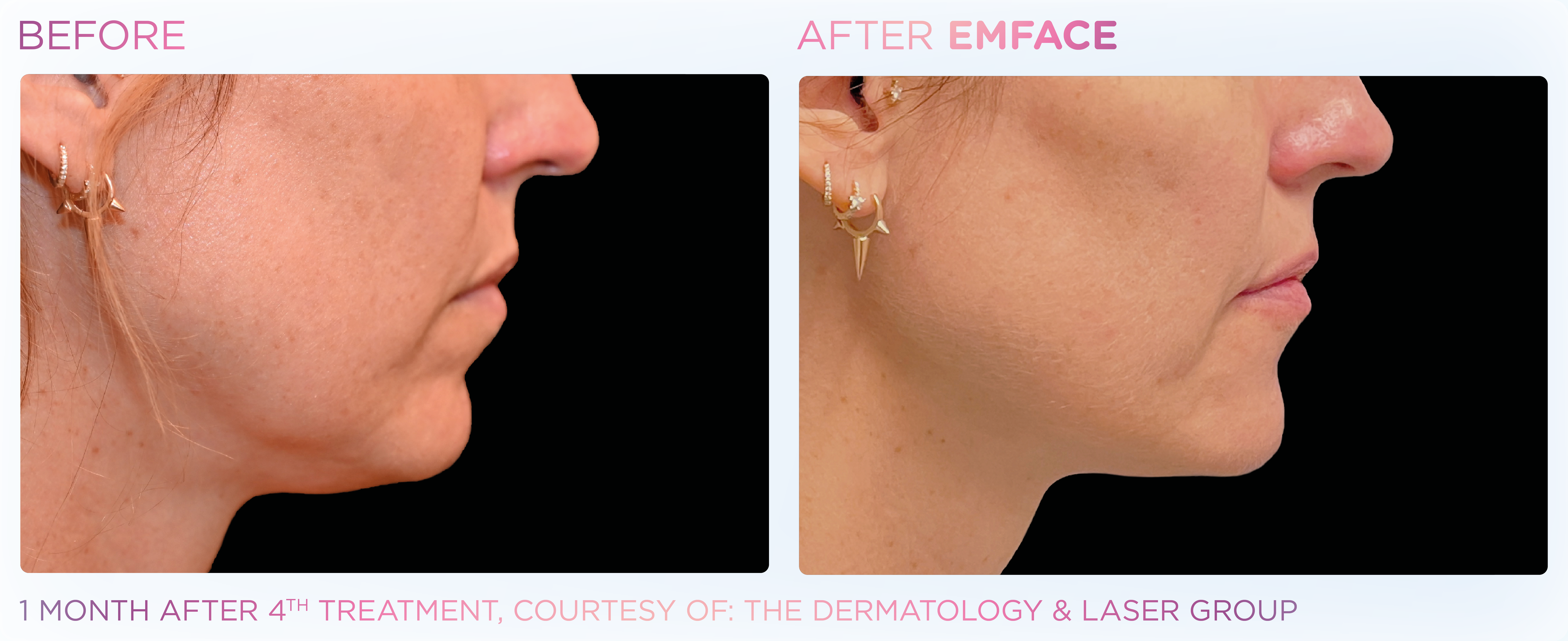 Jawline Contouring, manufacturer before-and-after example 4; before on the left and after on the right