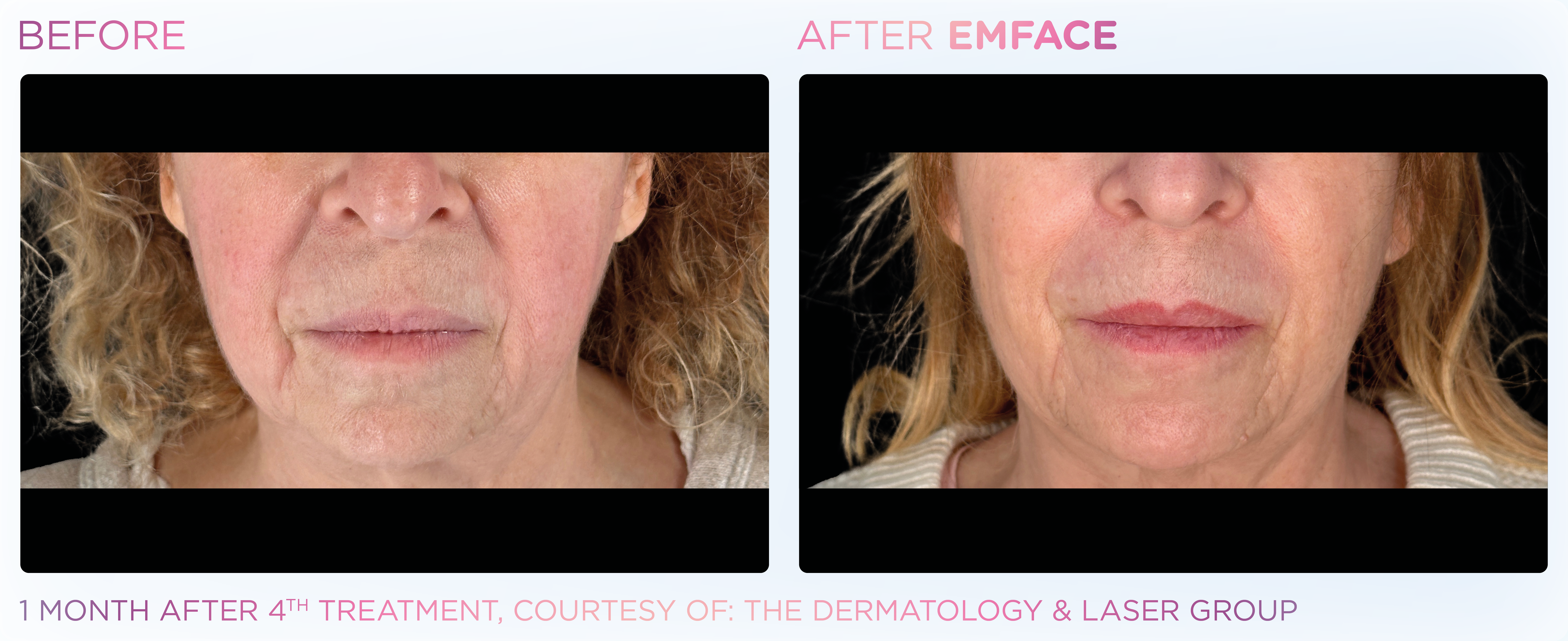 Jawline Contouring, manufacturer before-and-after example 5; before on the left and after on the right