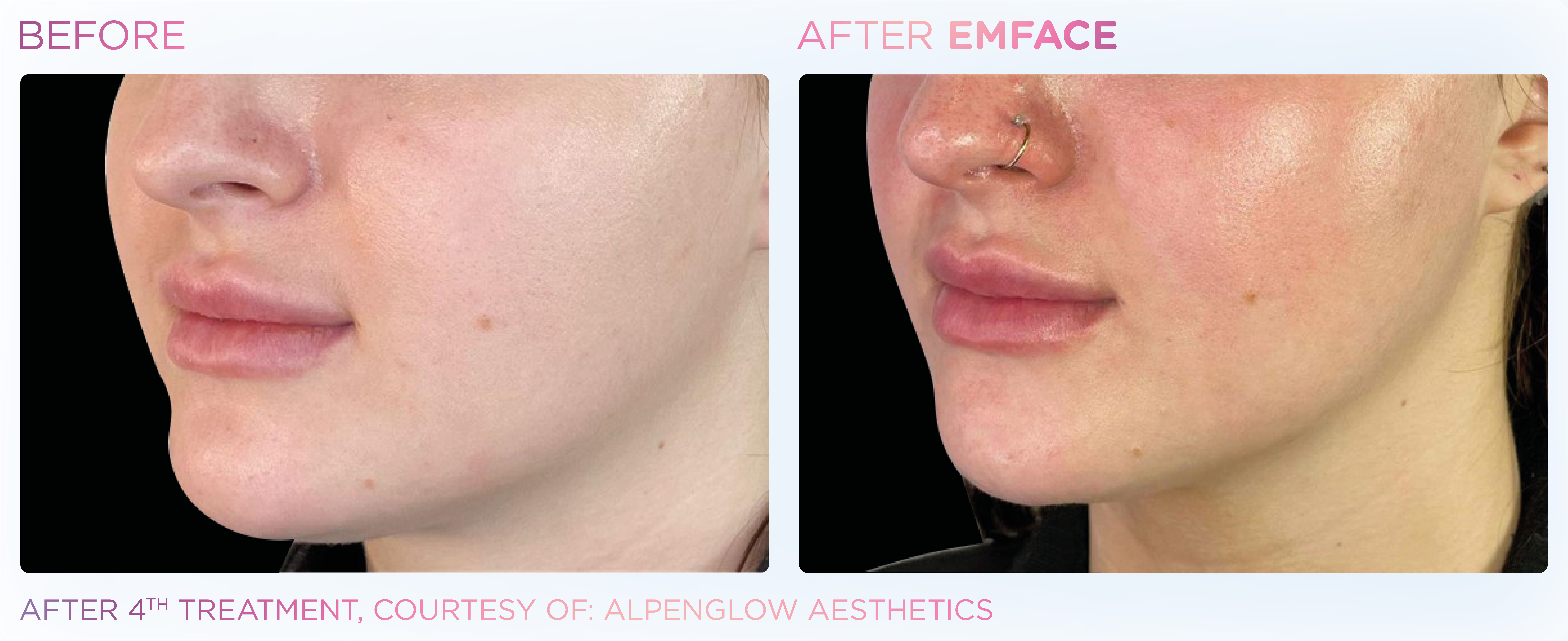 Jawline Contouring, manufacturer before-and-after example 6; before on the left and after on the right