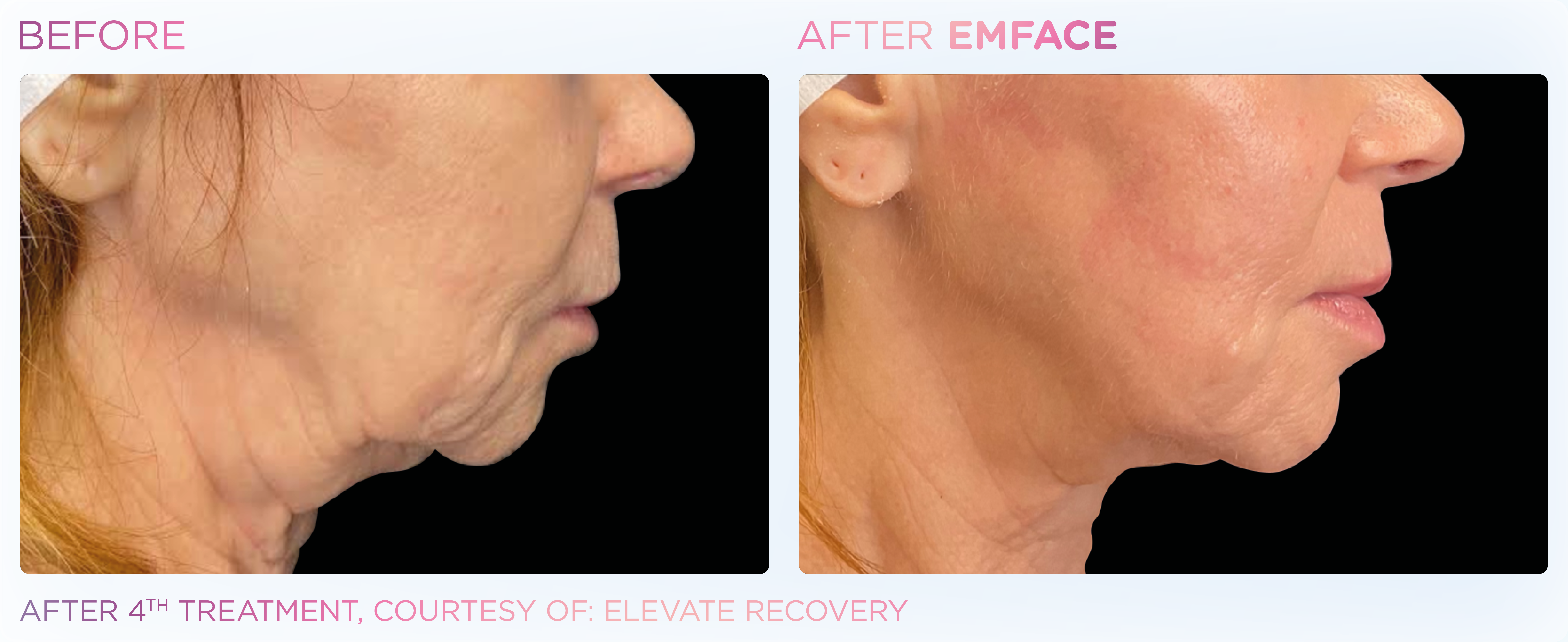 Jawline Contouring, manufacturer before-and-after example 7; before on the left and after on the right