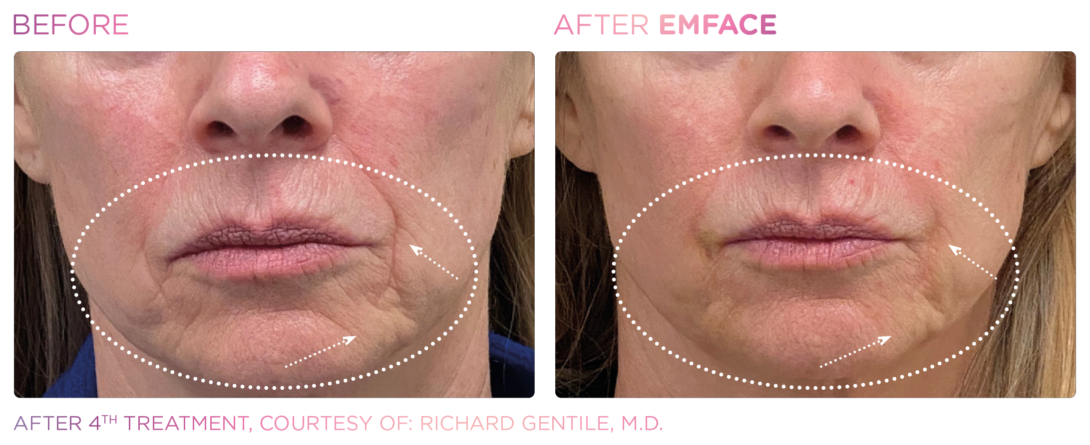 Facial Rejuvenation, manufacturer before-and-after example 27; before on the left and after on the right