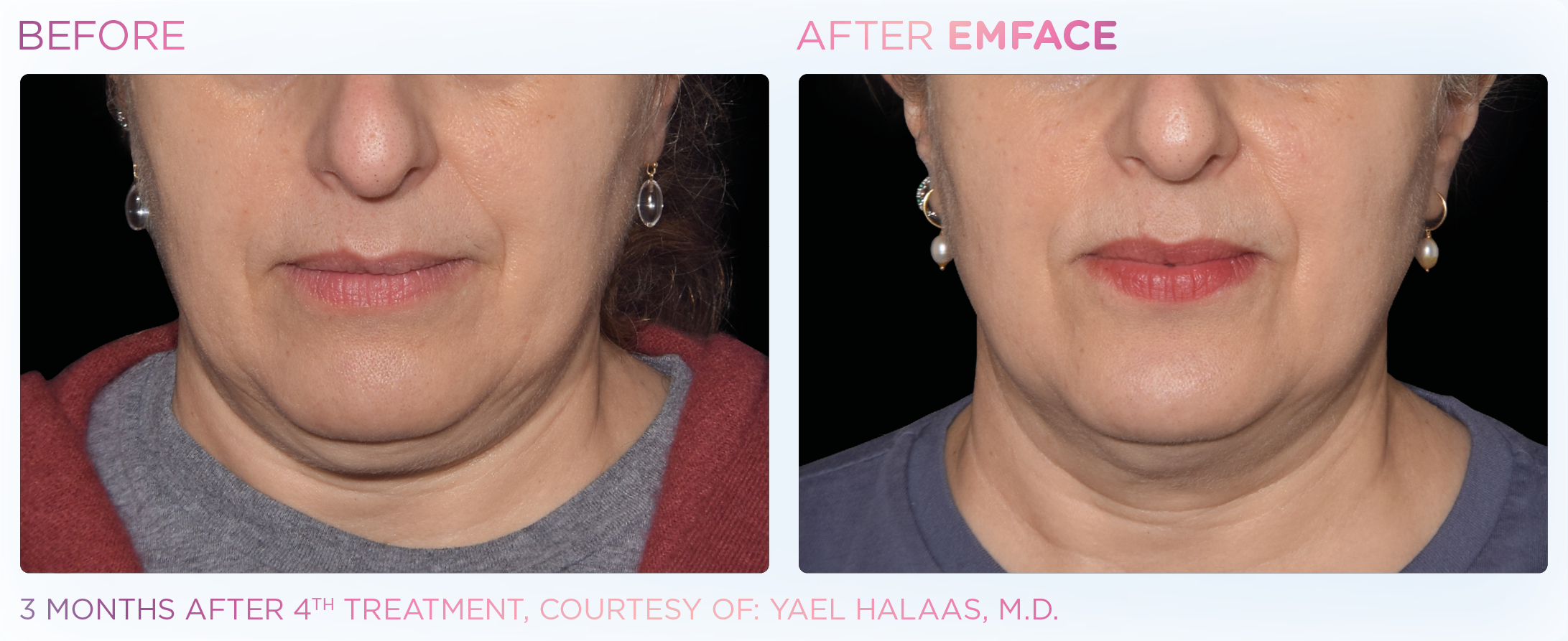 Double Chin Treatment, manufacturer before-and-after example 2; before on the left and after on the right