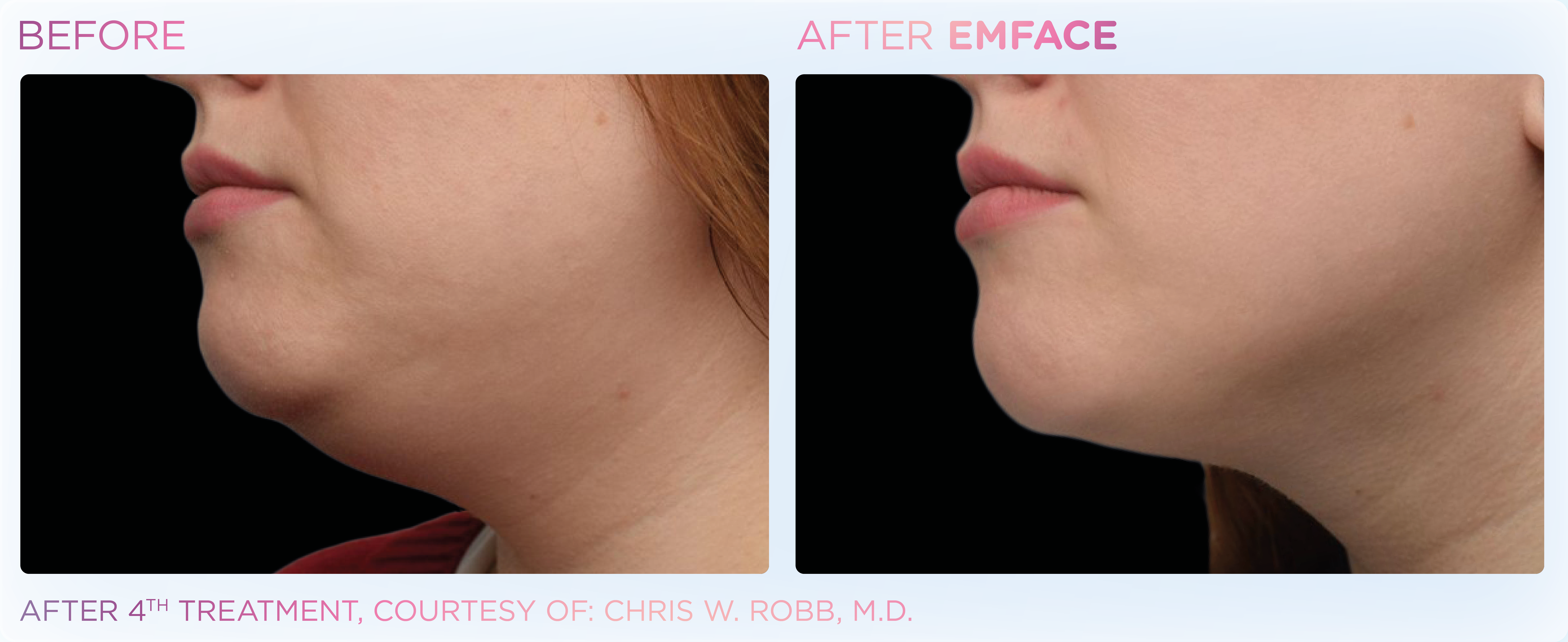 Double Chin Treatment, manufacturer before-and-after example 3; before on the left and after on the right