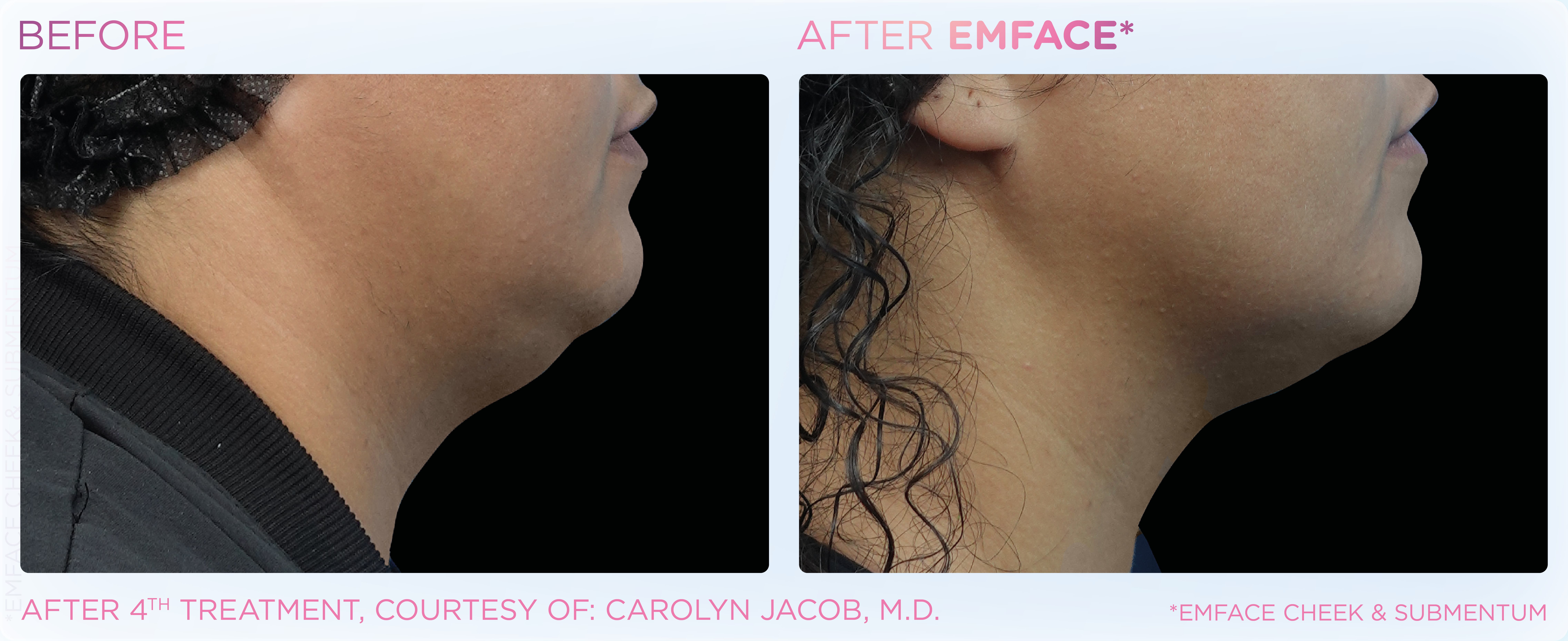 Double Chin Treatment, manufacturer before-and-after example 4; before on the left and after on the right