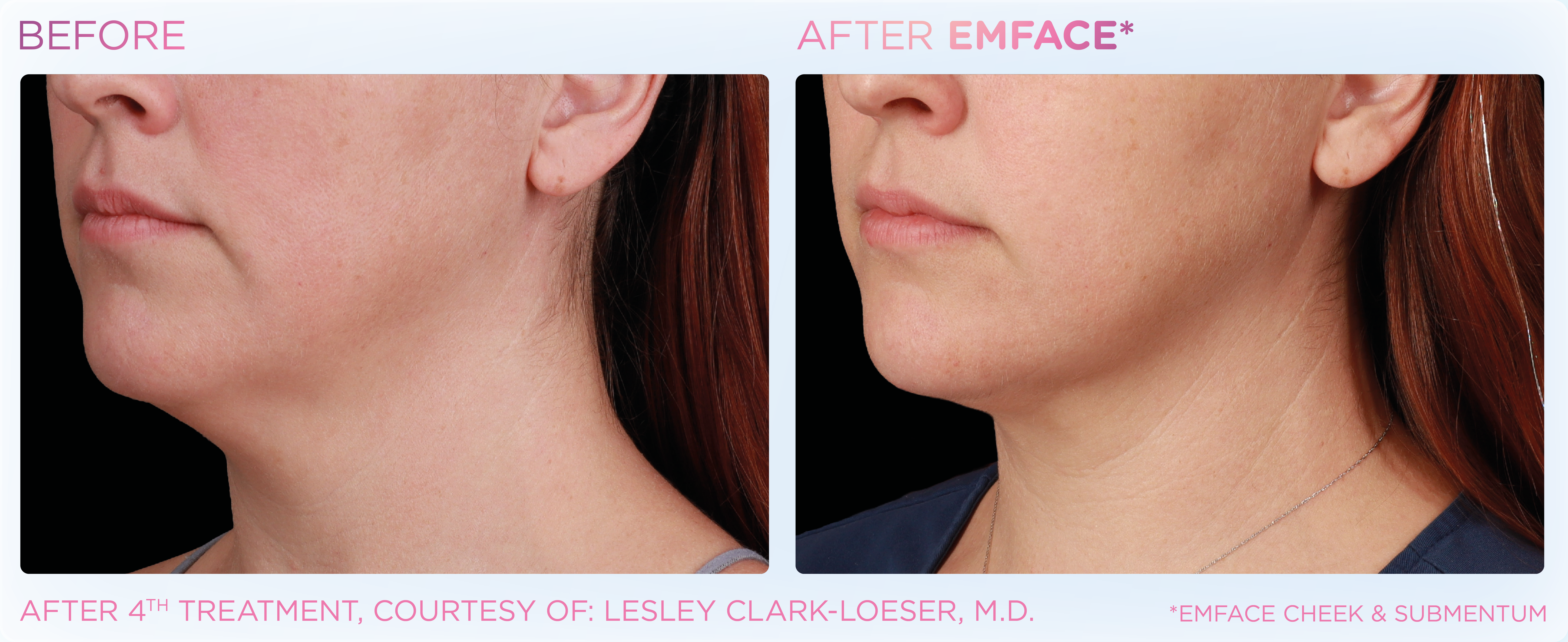 Double Chin Treatment, manufacturer before-and-after example 5; before on the left and after on the right
